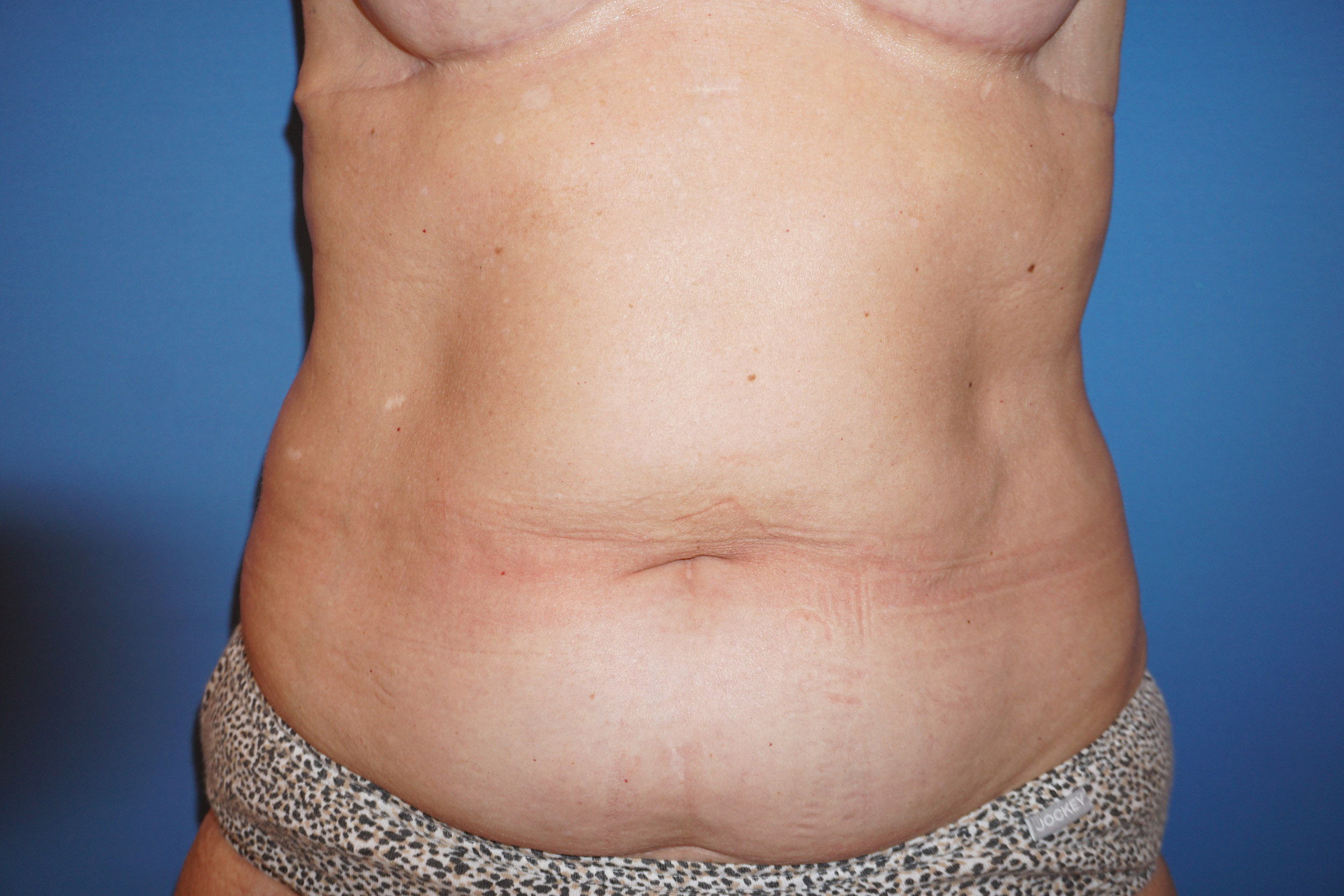 Liposuction – Patient 4 Before
