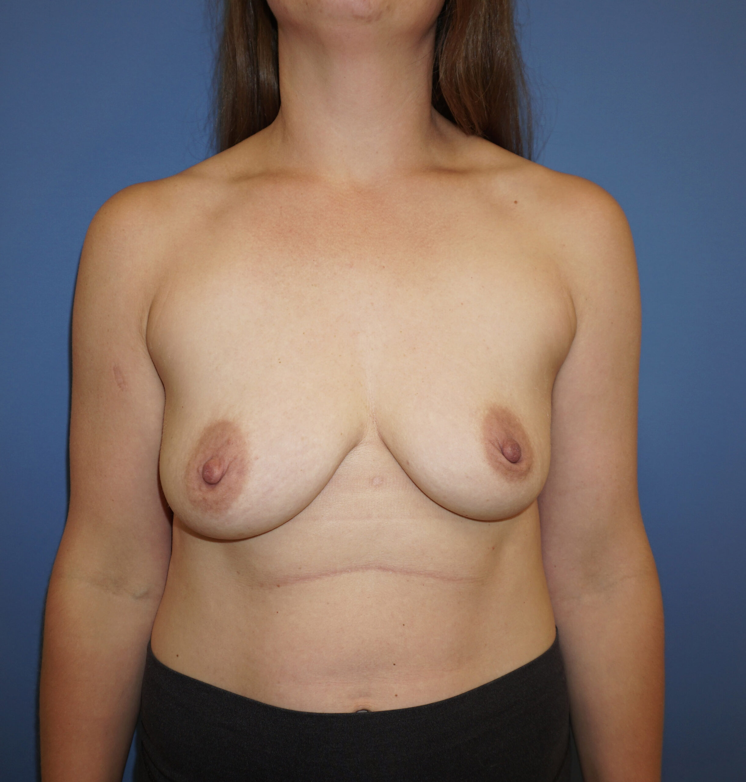 Breast Lift with Implant – Patient 3 Before
