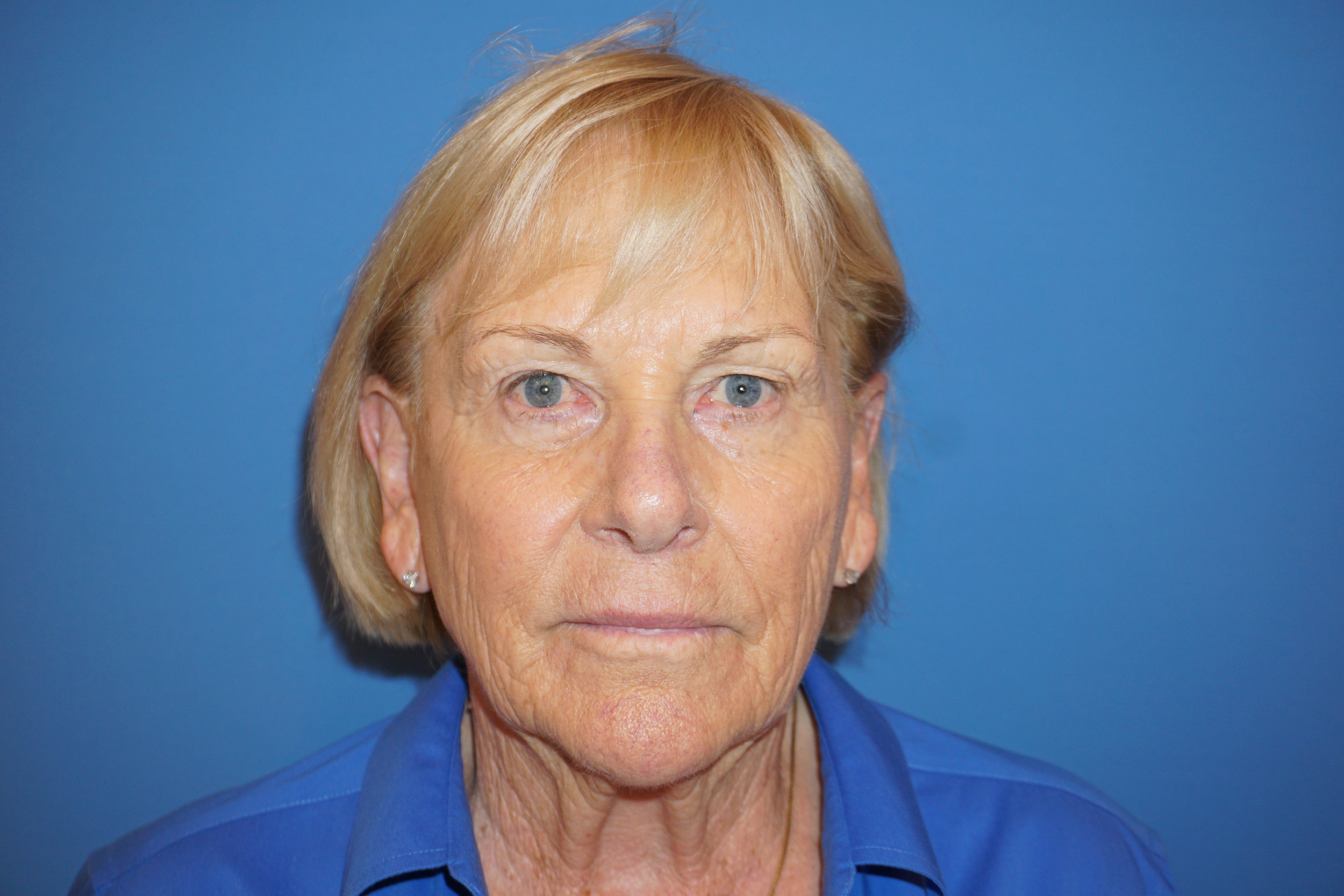 Blepharoplasty – Patient 4 Before