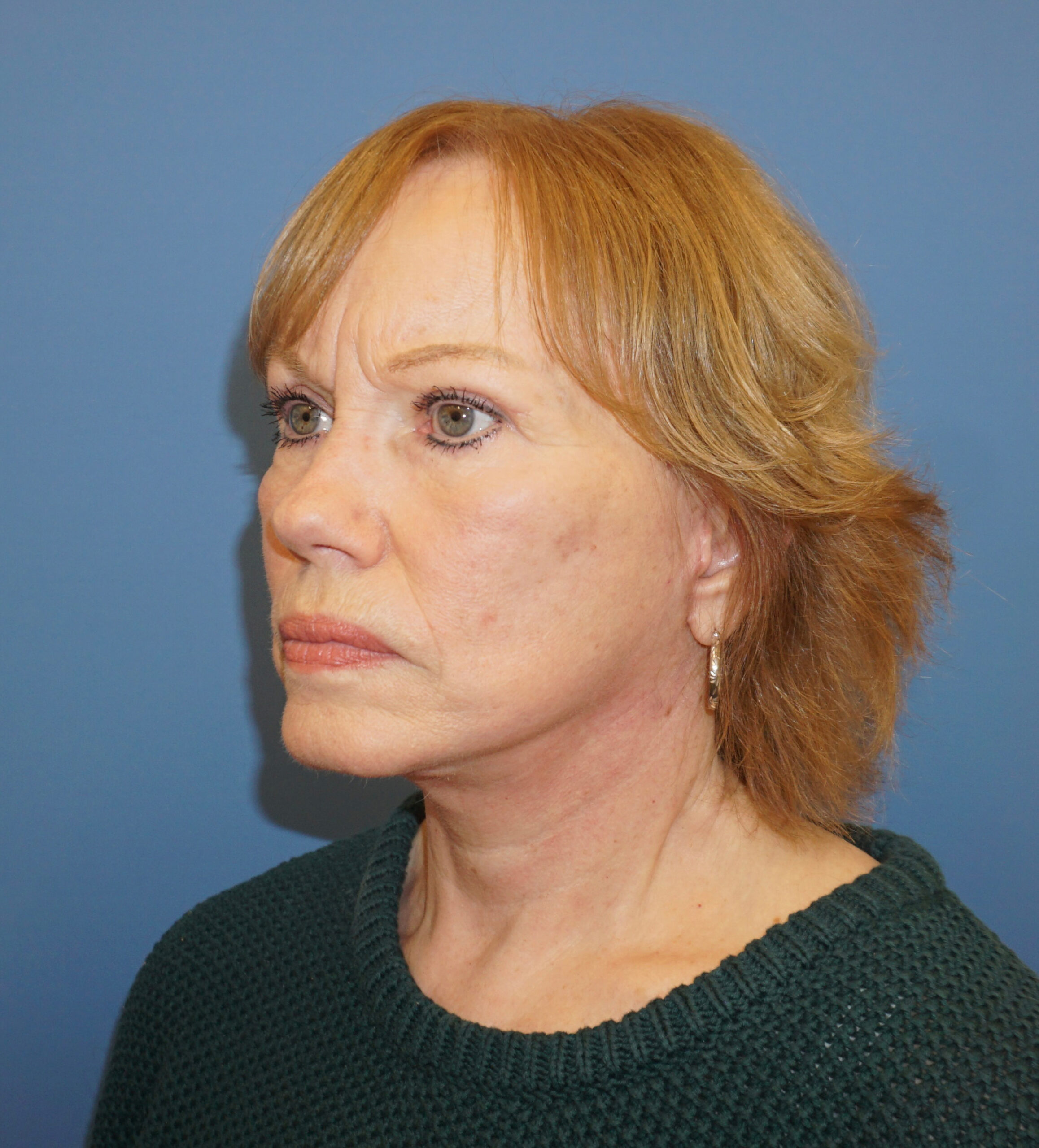 Facelift Patient 4 After