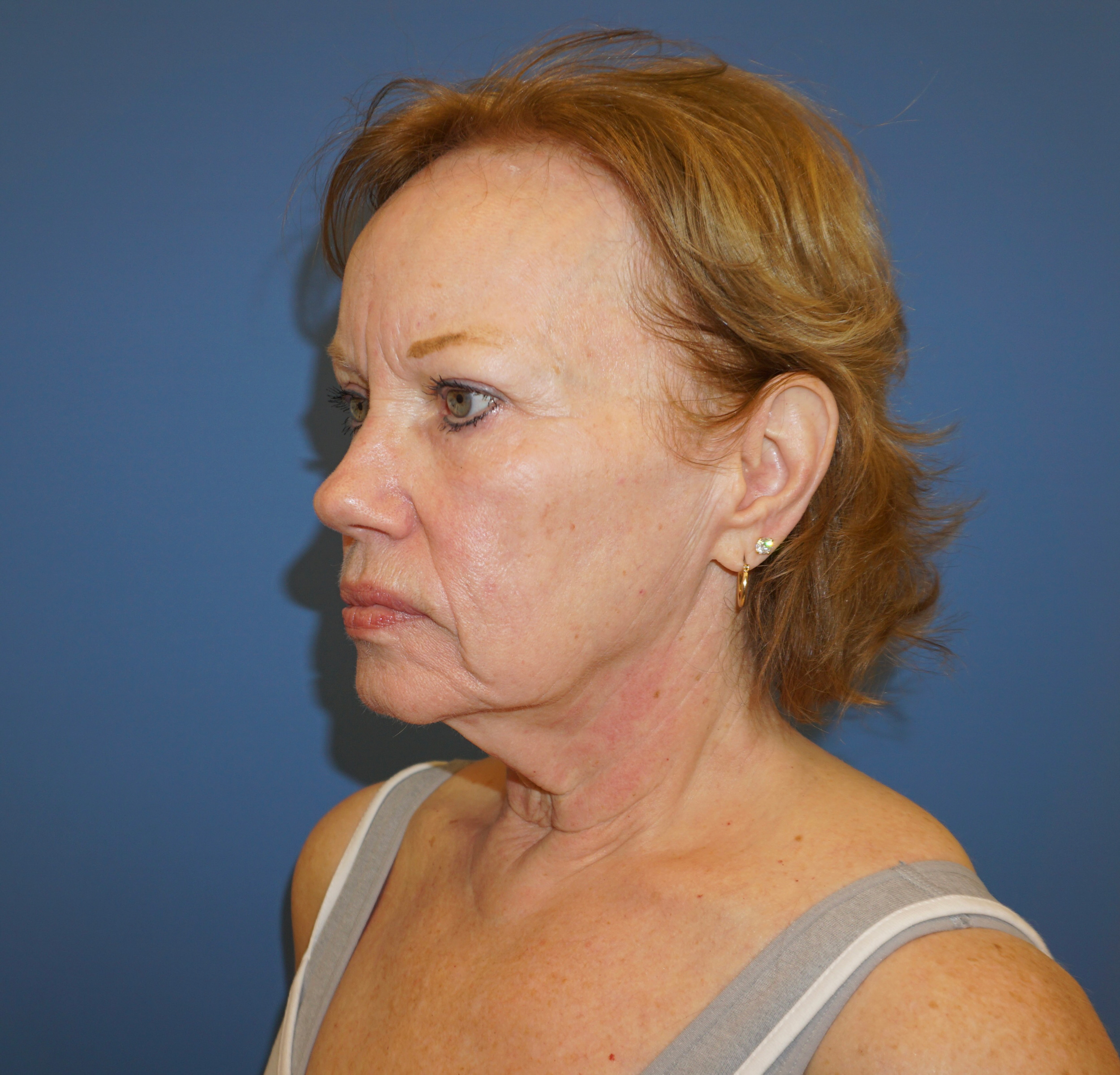 Facelift Patient 4 Before