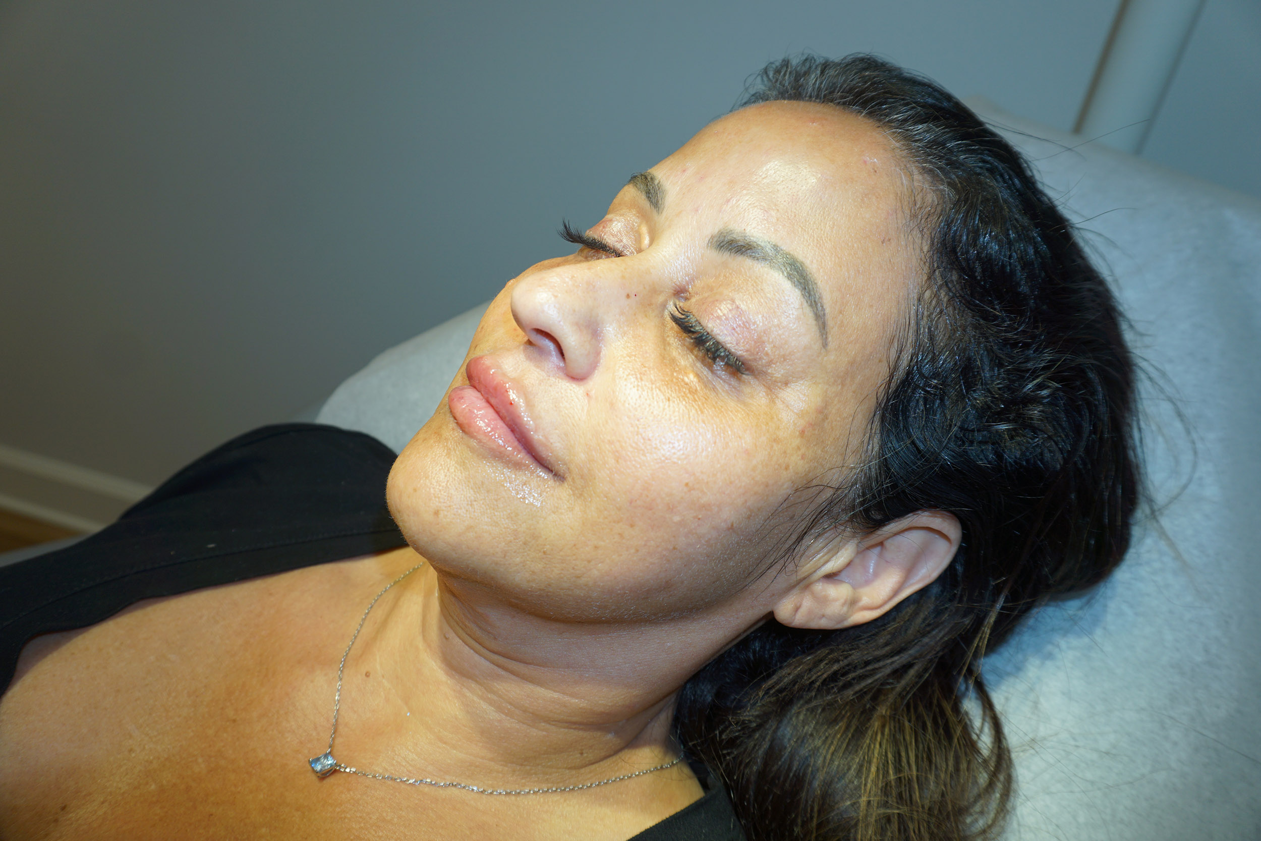 Botox – Patient 5 After
