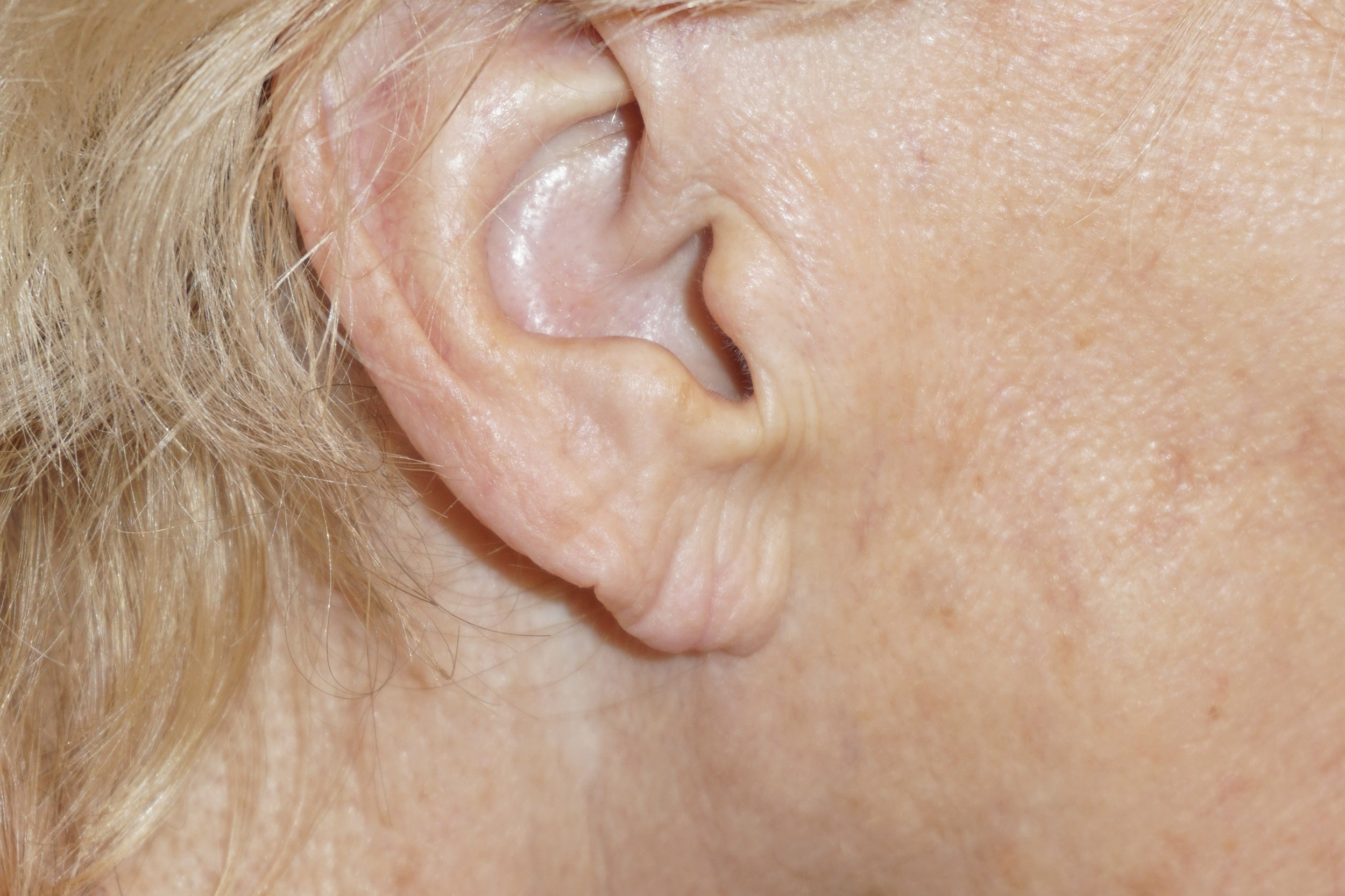 Ear Surgery – Patient 5 After