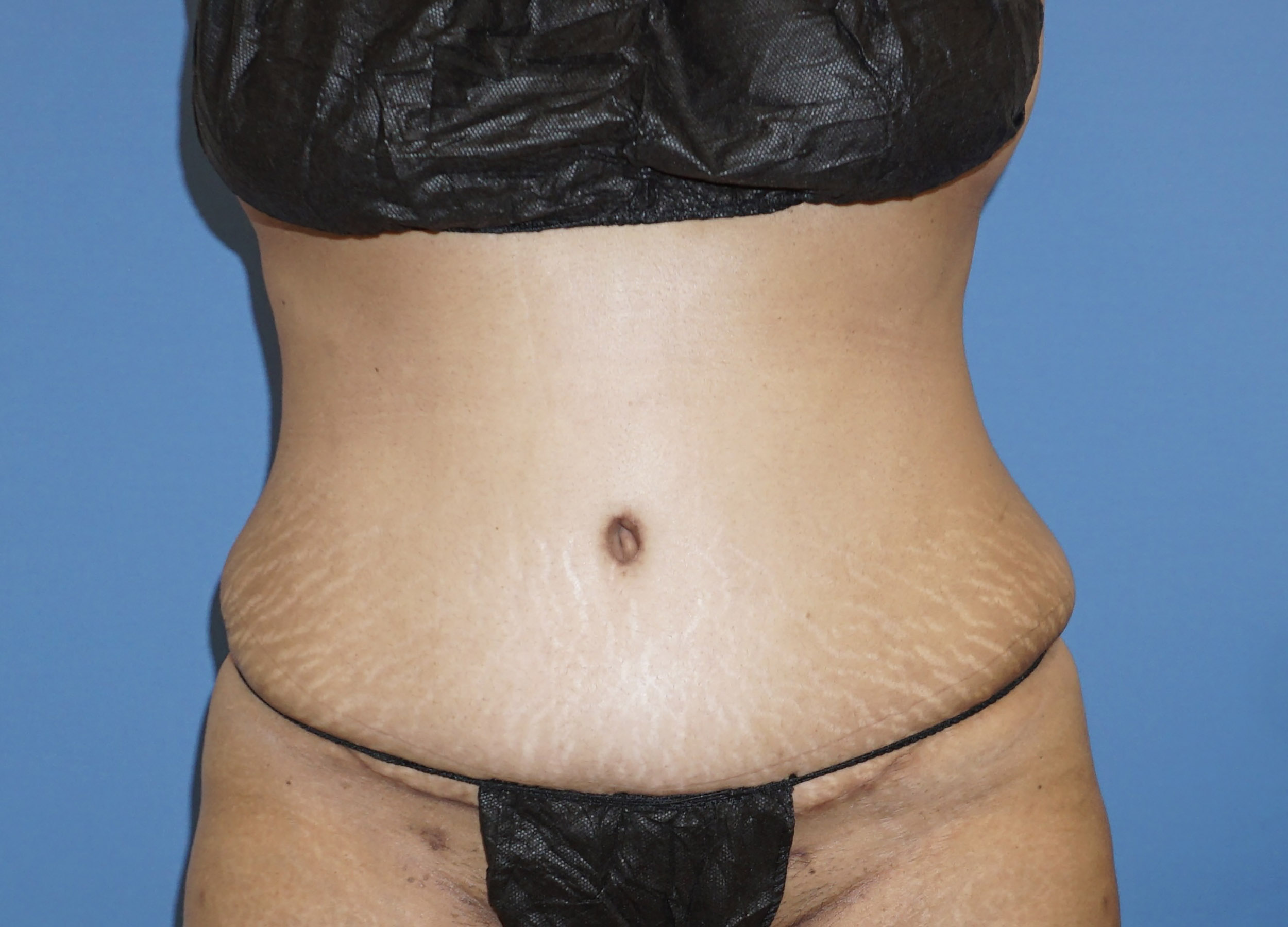 Tummy Tuck – Patient 5 After