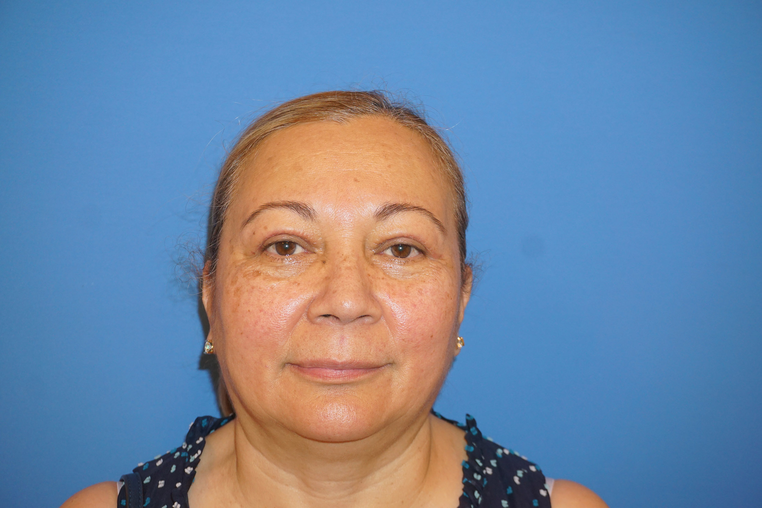 Blepharoplasty – Patient 5 After