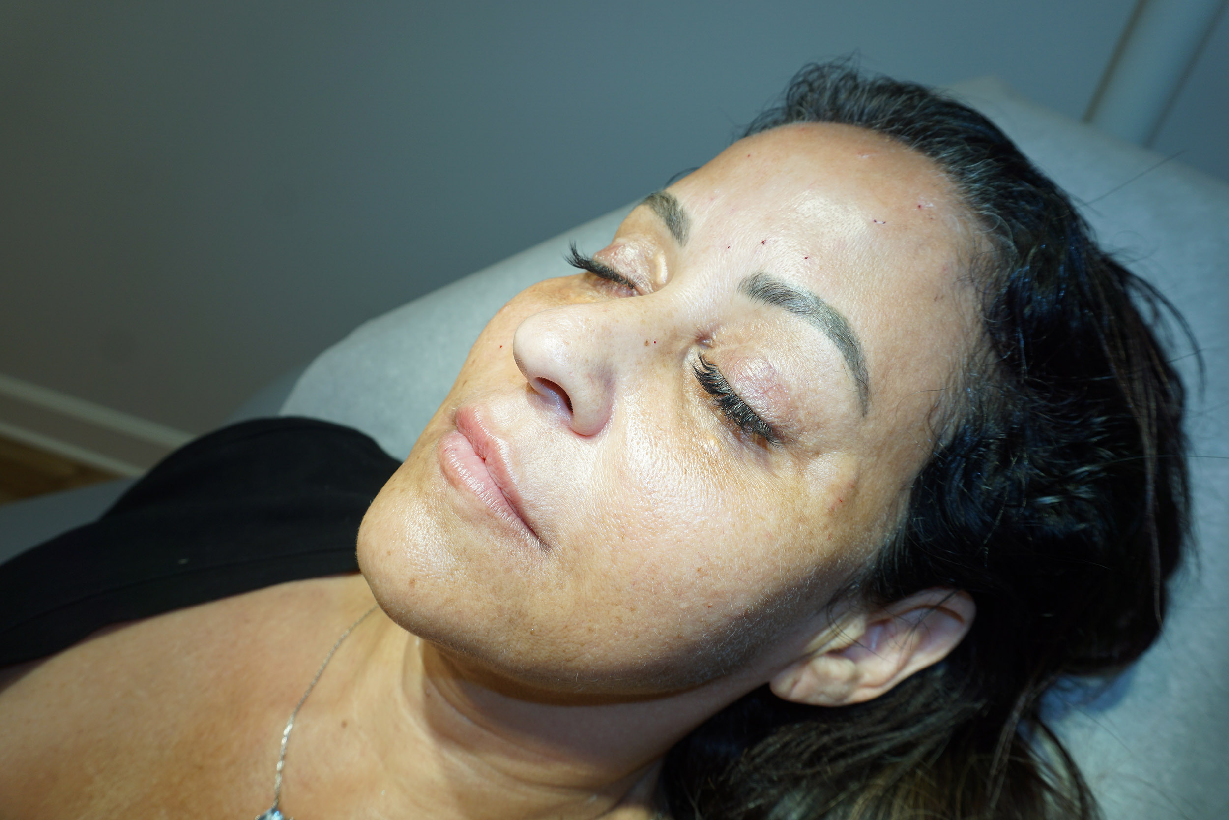 Botox – Patient 5 Before