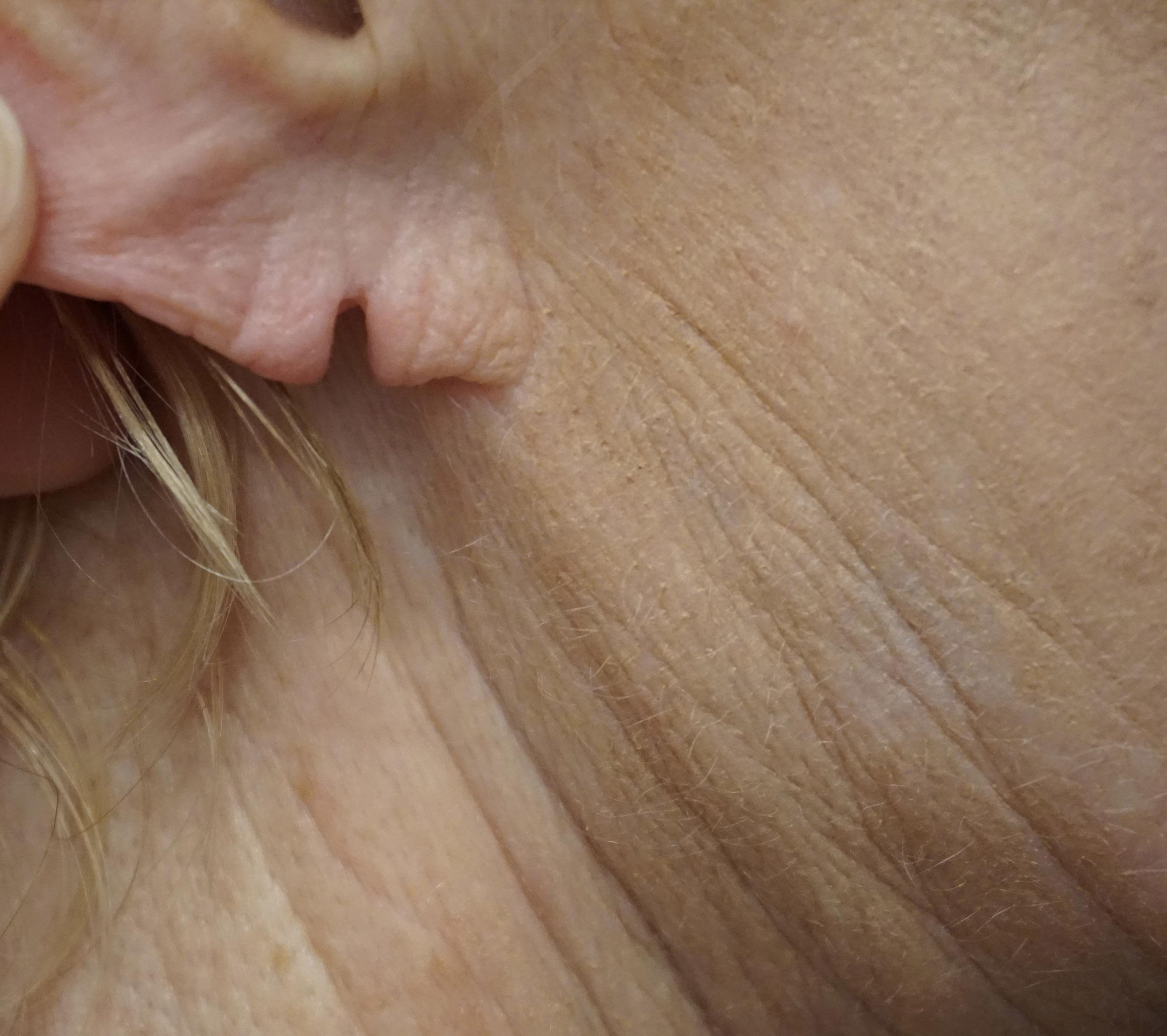 Ear Surgery – Patient 5 Before