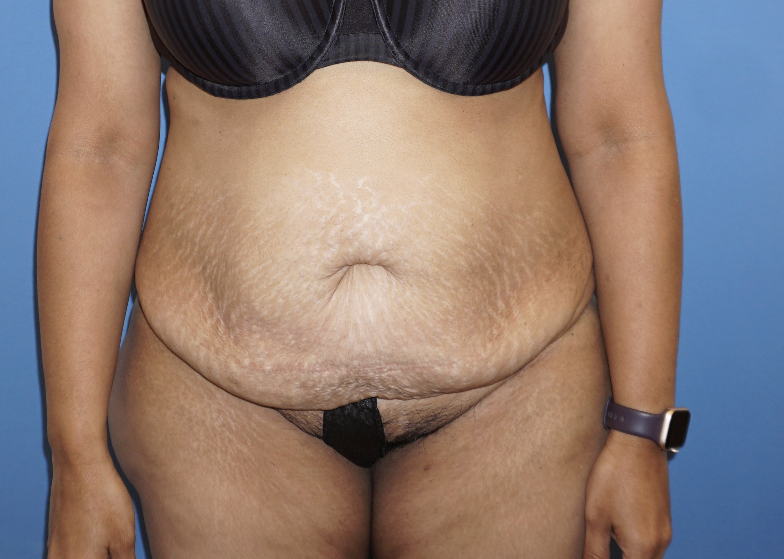 Tummy Tuck – Patient 5 Before