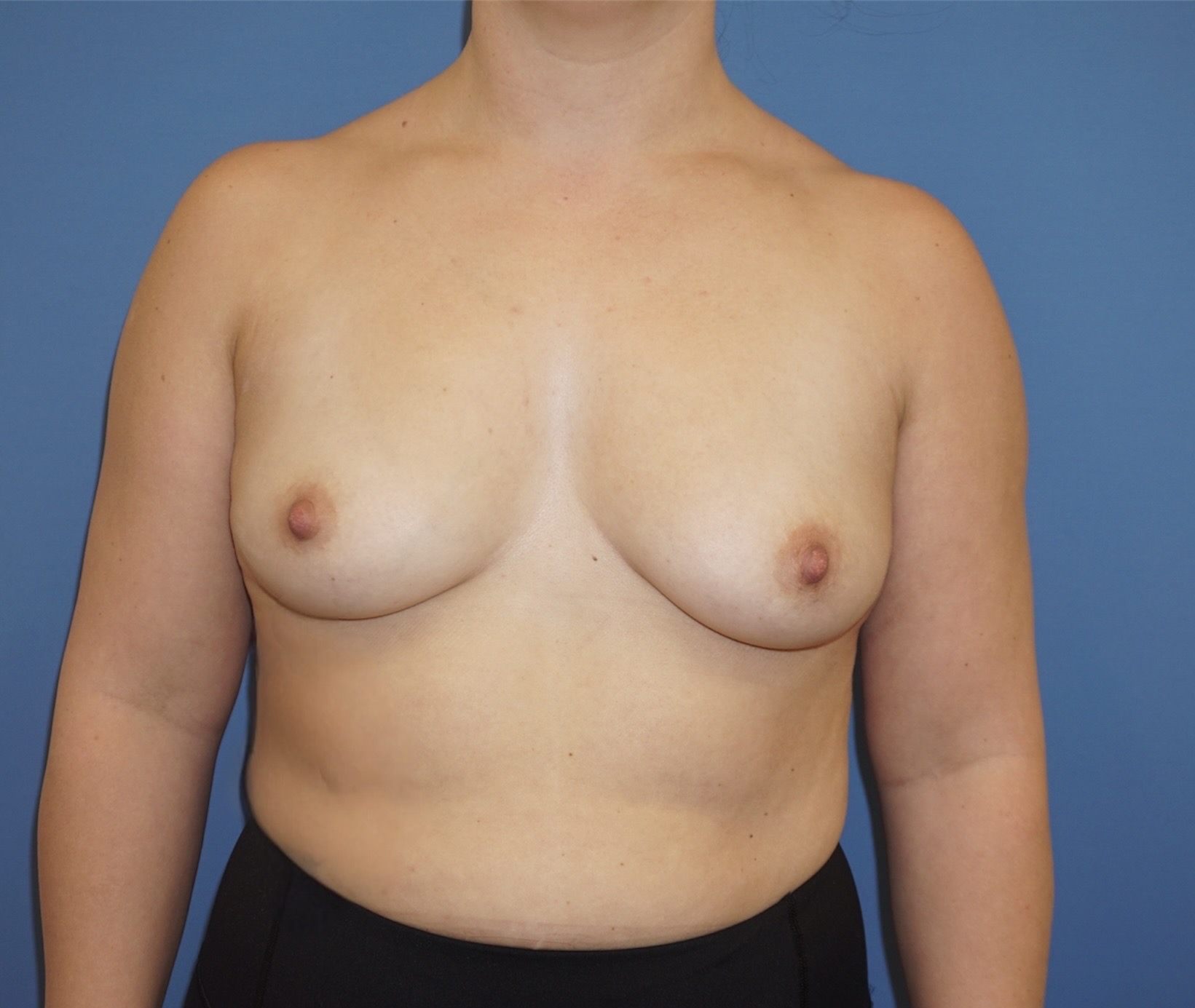 Breast Augmentation – Patient 5 Before