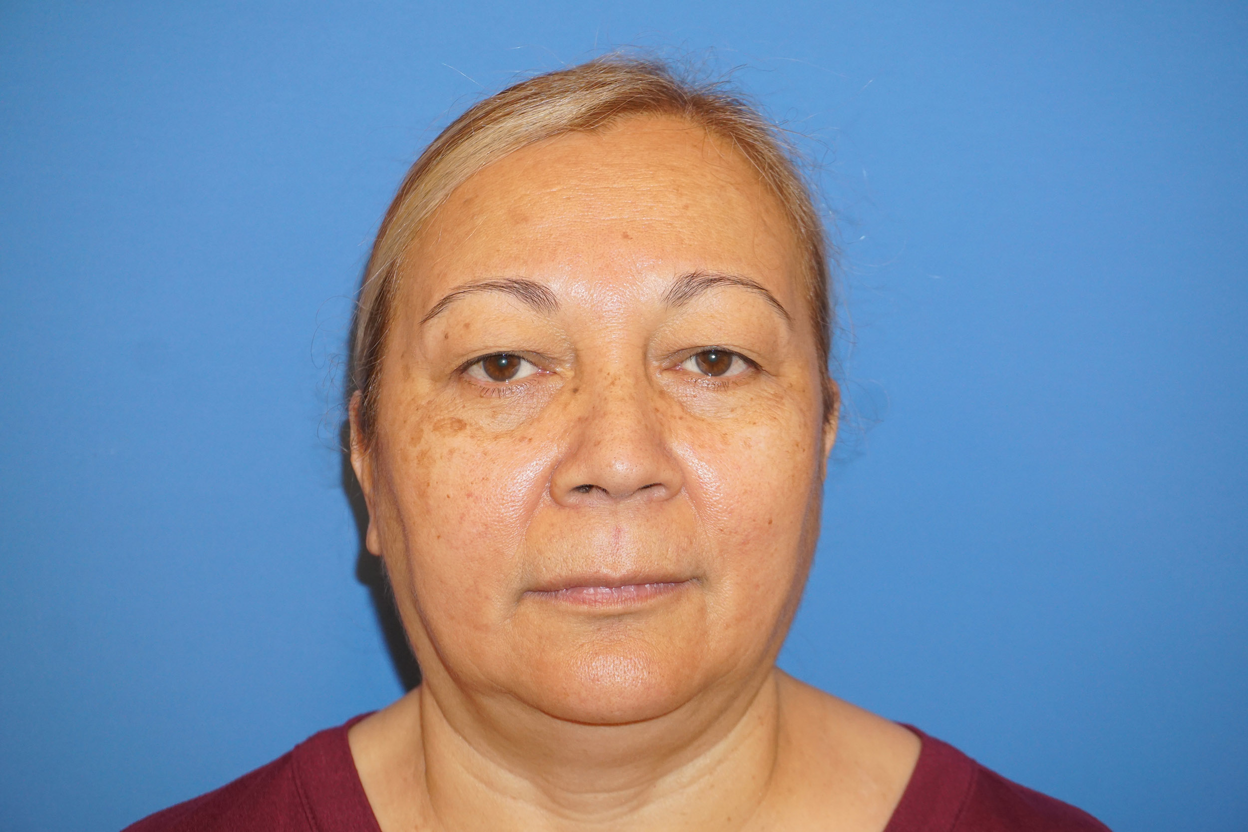 Blepharoplasty – Patient 5 Before