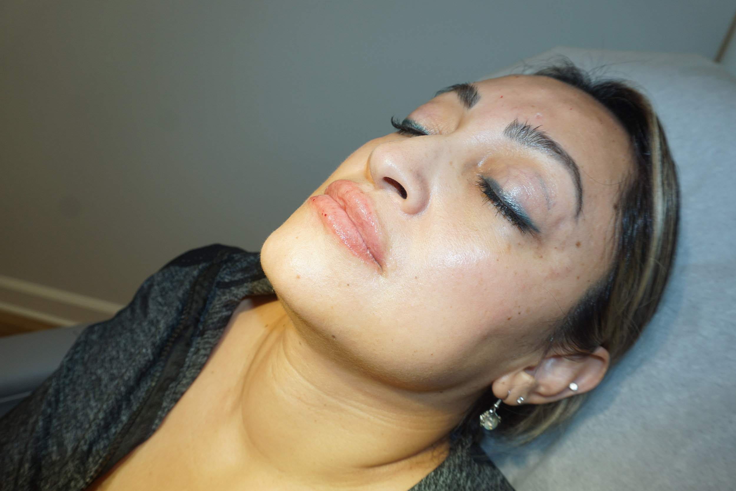 Botox – Patient 6 After