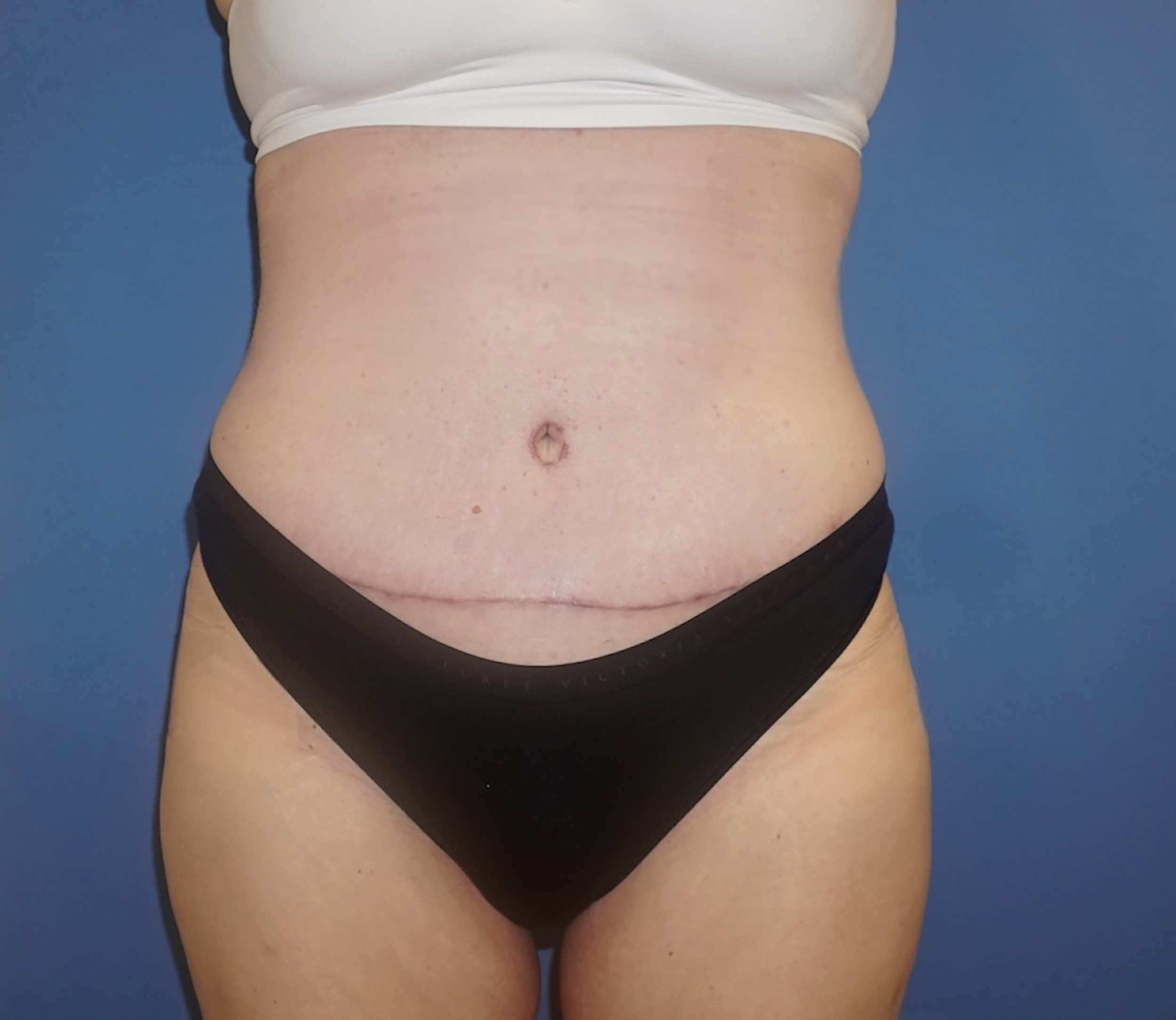 Tummy Tuck – Patient 6 After