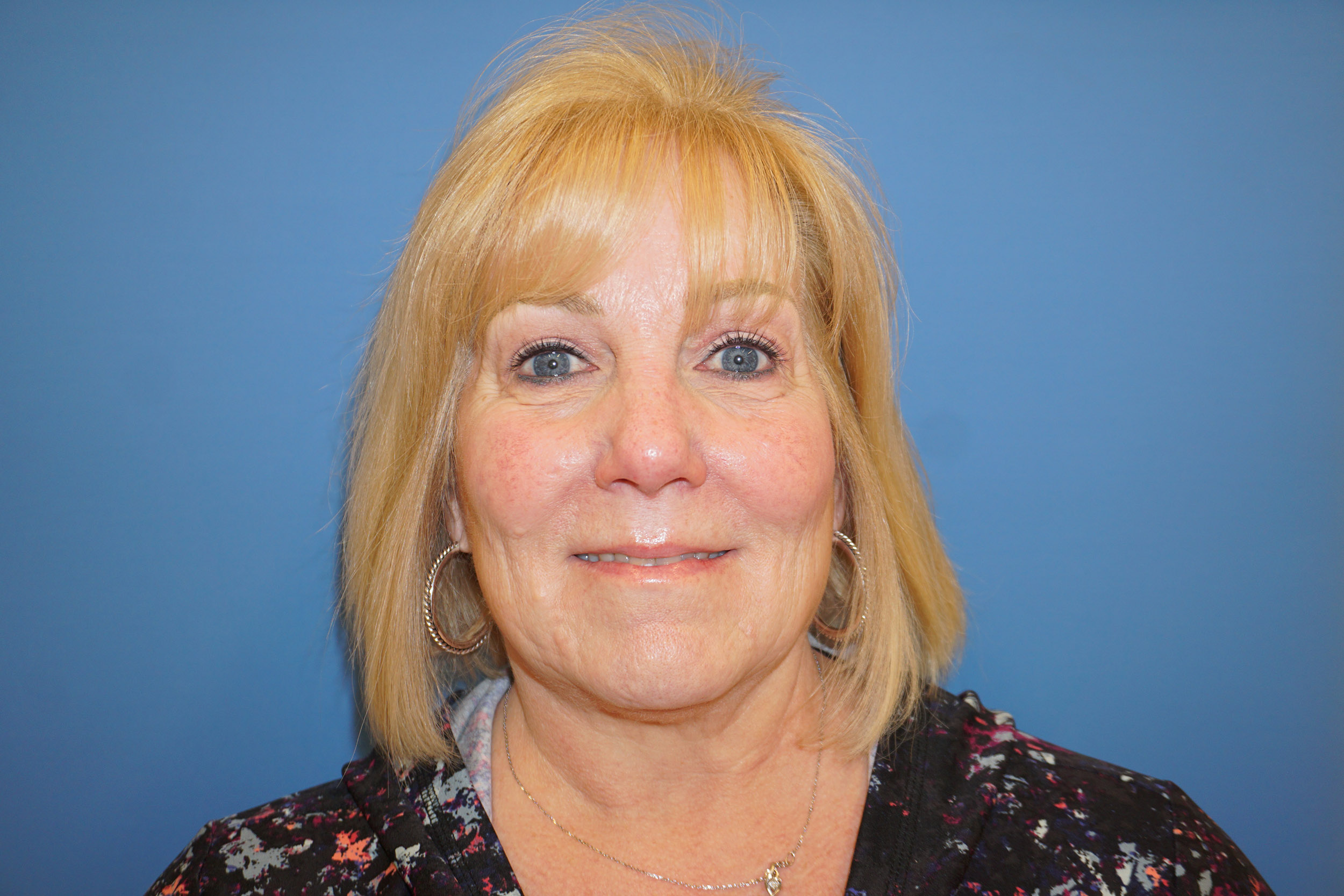 Blepharoplasty – Patient 6 After