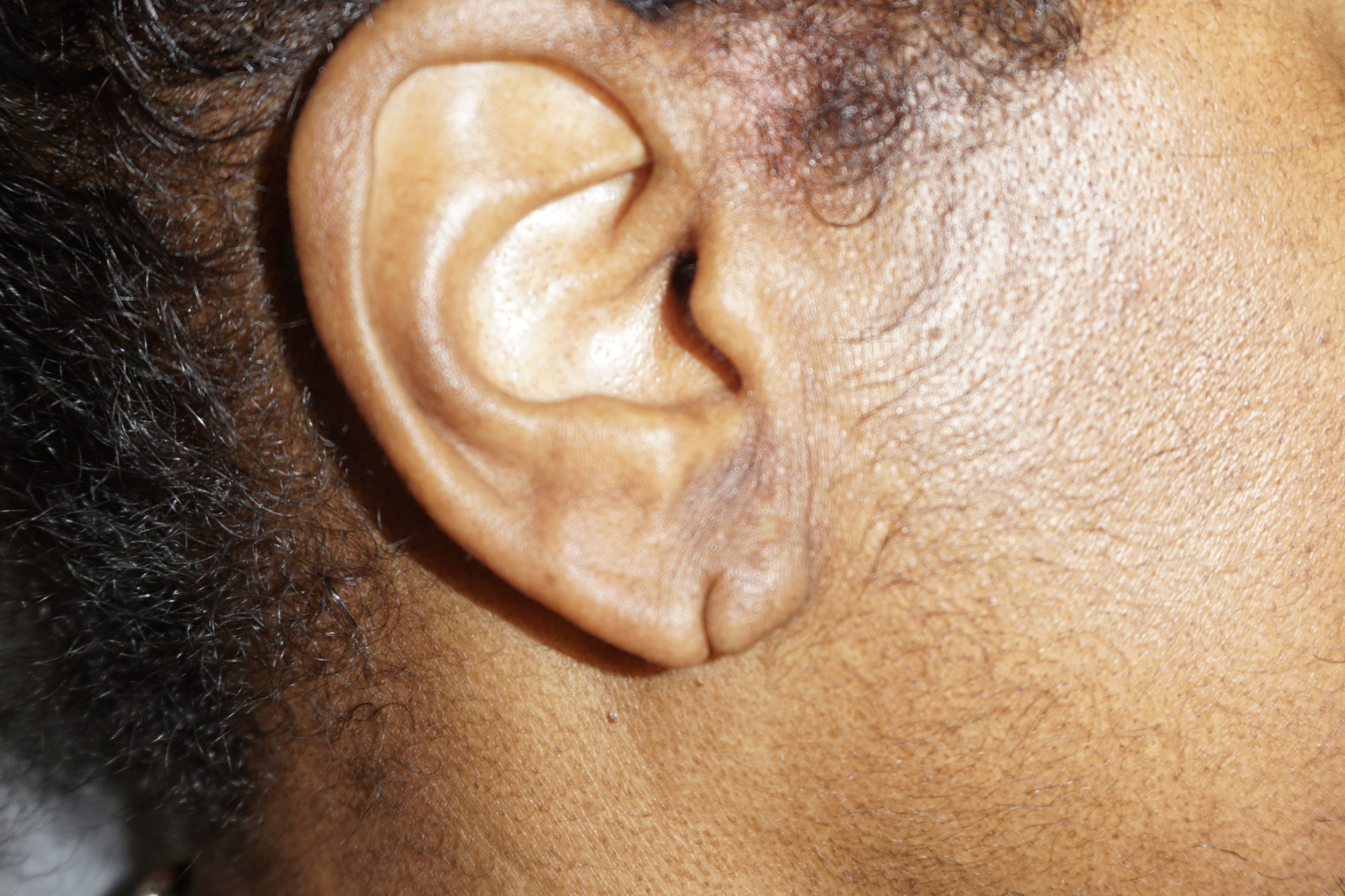 Ear Surgery – Patient 6 Before