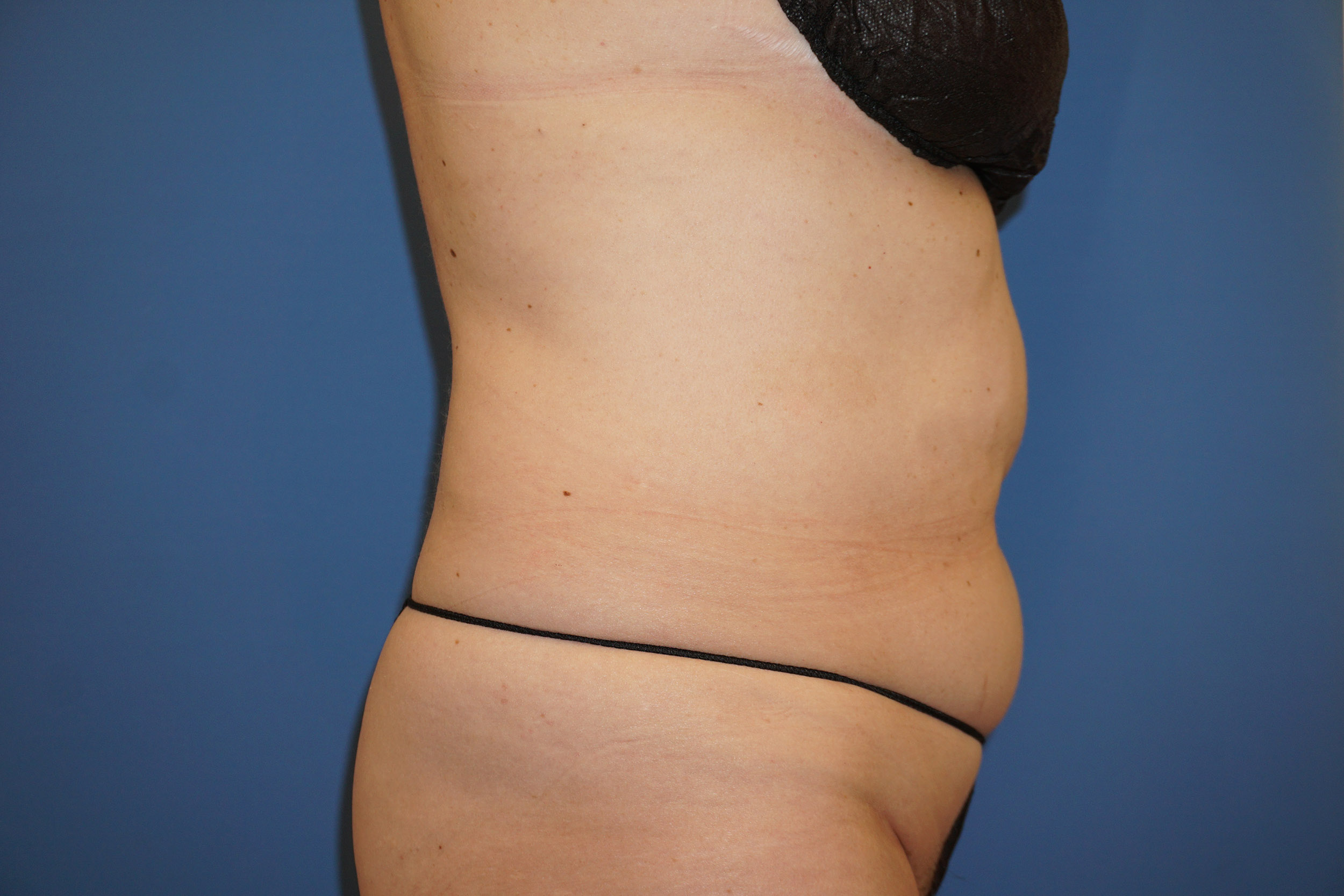 Liposuction – Patient 6 Before