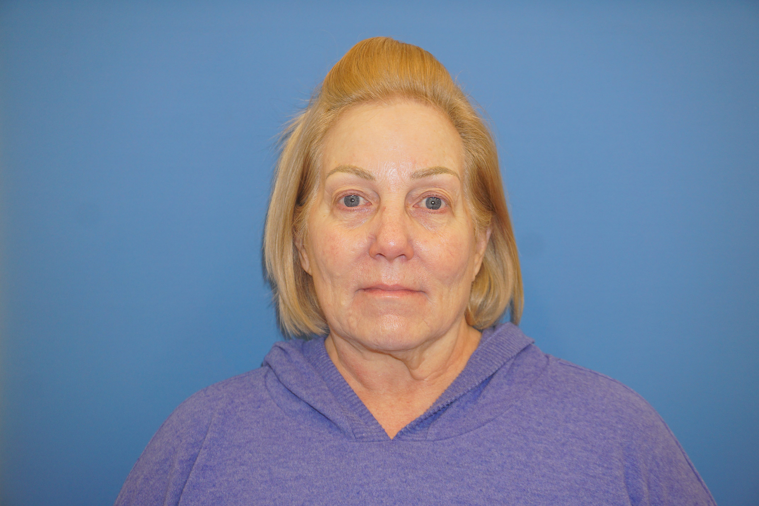 Blepharoplasty – Patient 6 Before