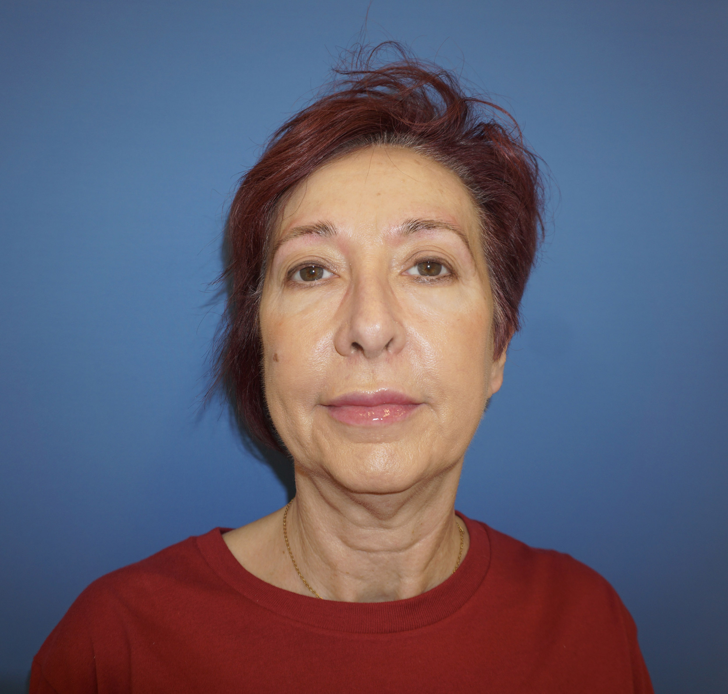 Botox – Patient 7 After