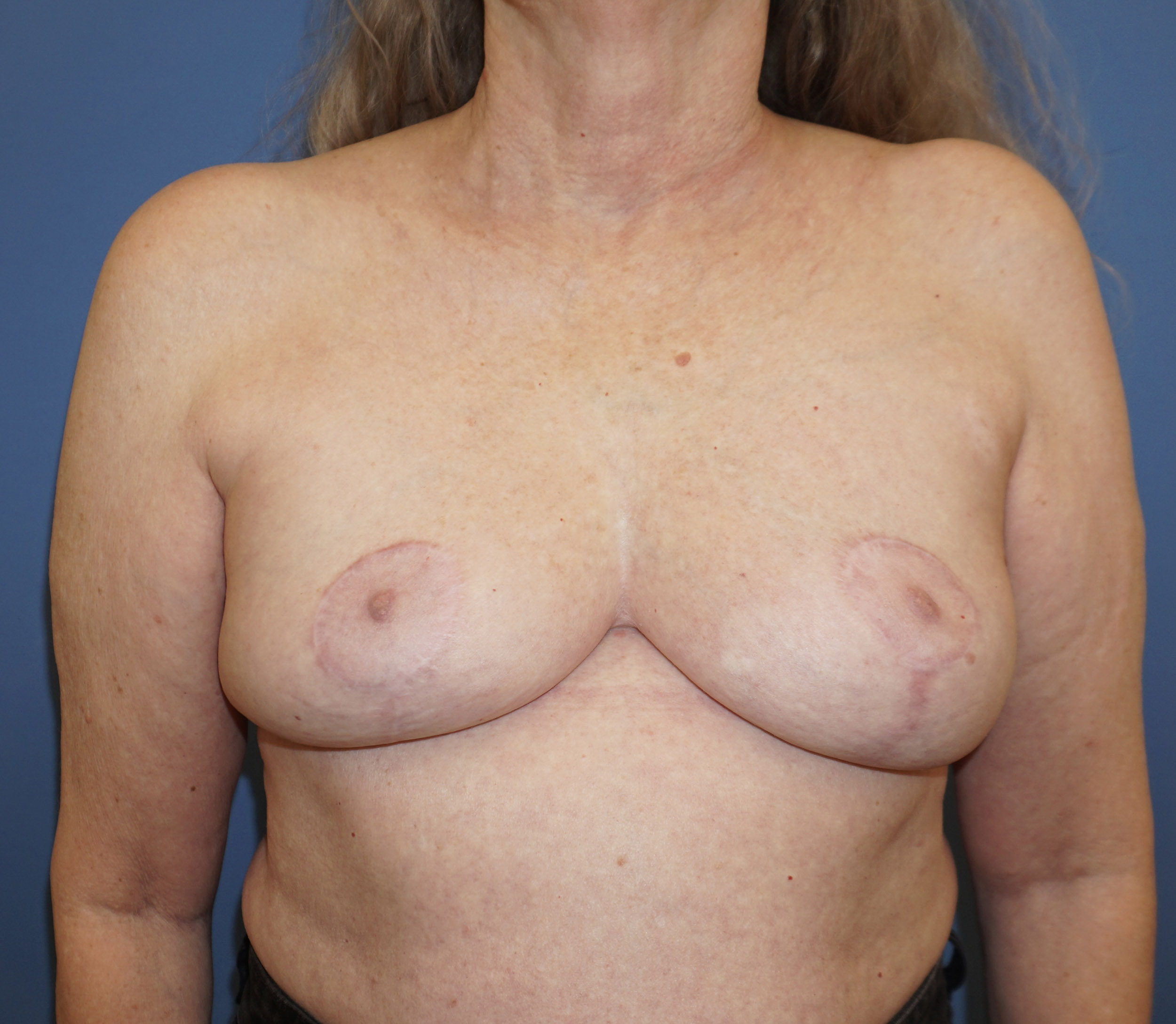 Breast Implant Removal – Patient 7 After