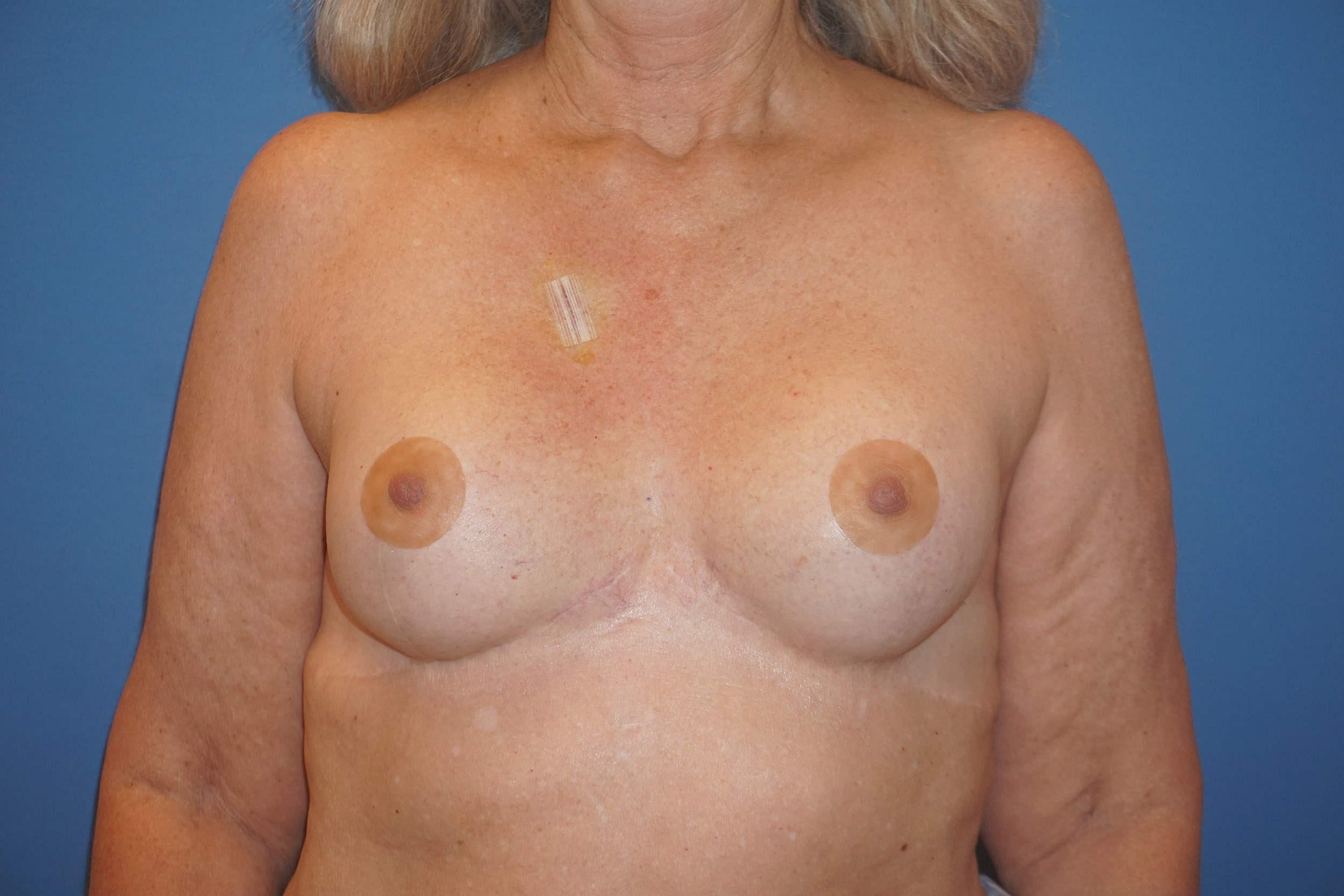 Breast Reconstruction for Cancer – Patient 7 After
