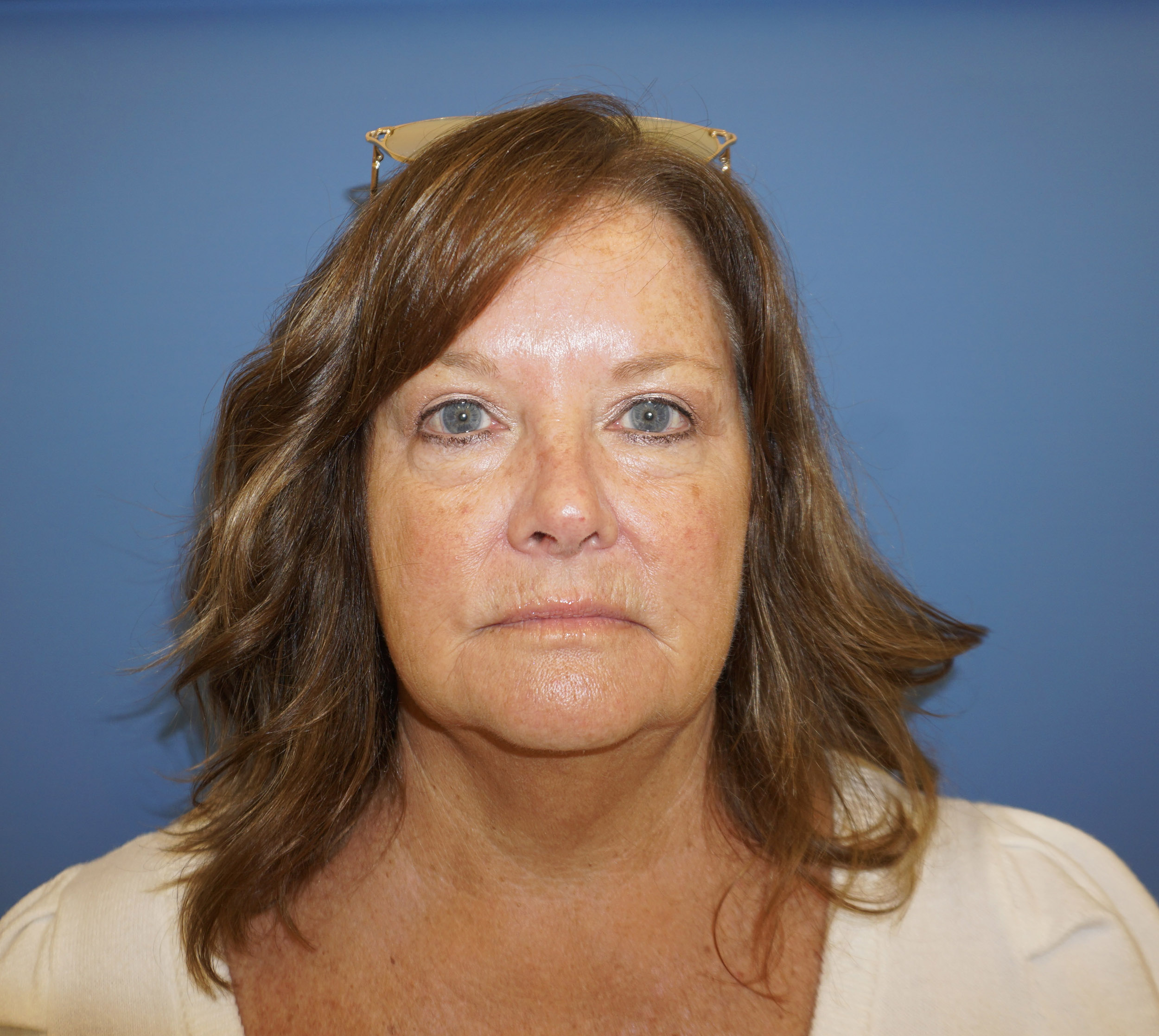 Blepharoplasty – Patient 7 After