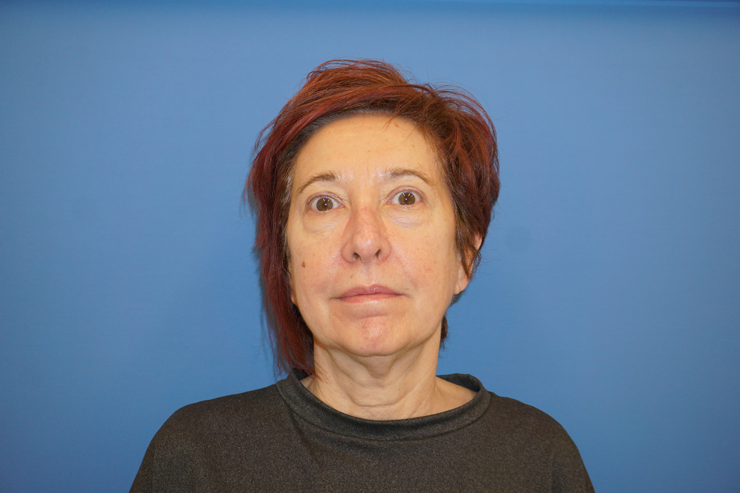 Botox – Patient 7 Before