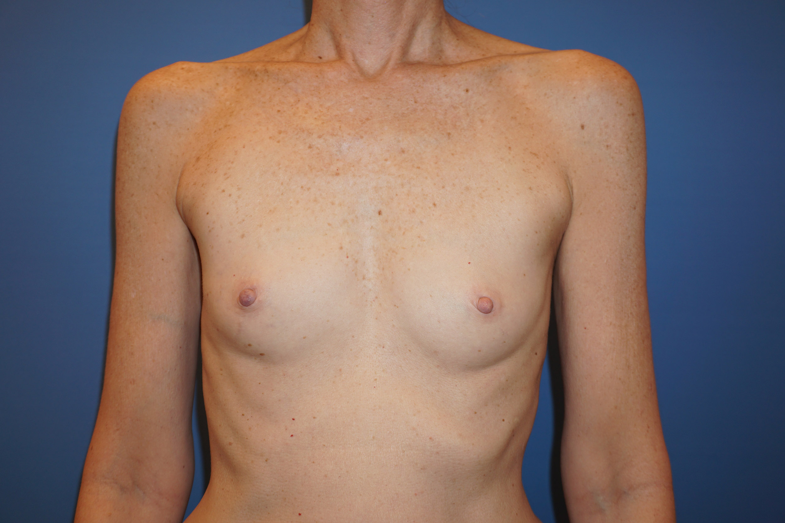 Breast Augmentation – Patient 7 Before