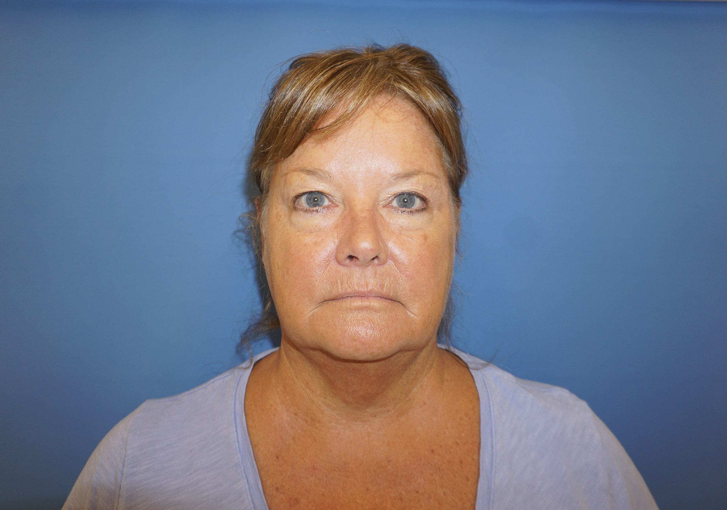 Blepharoplasty – Patient 7 Before