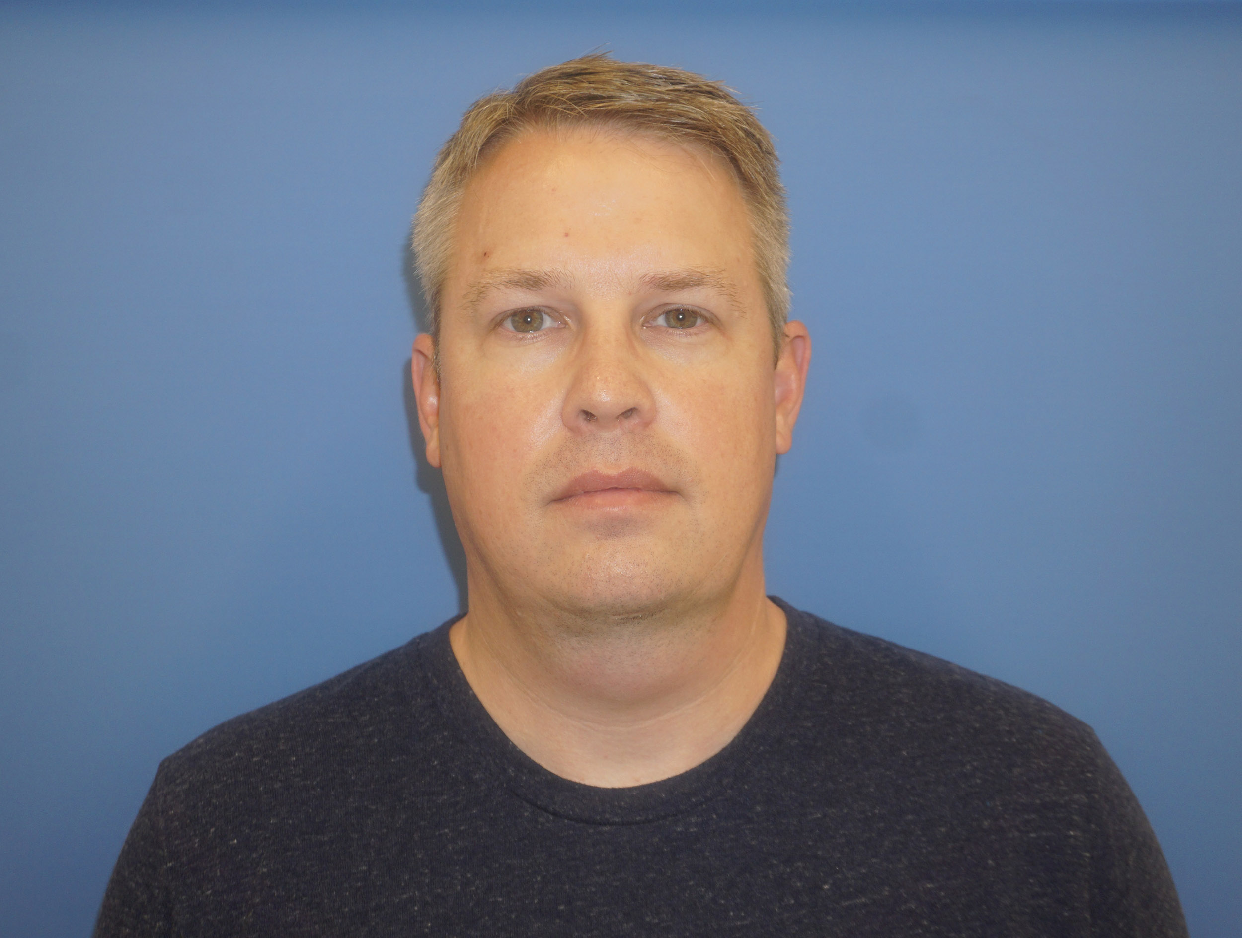 Liposuction – Patient 7 After