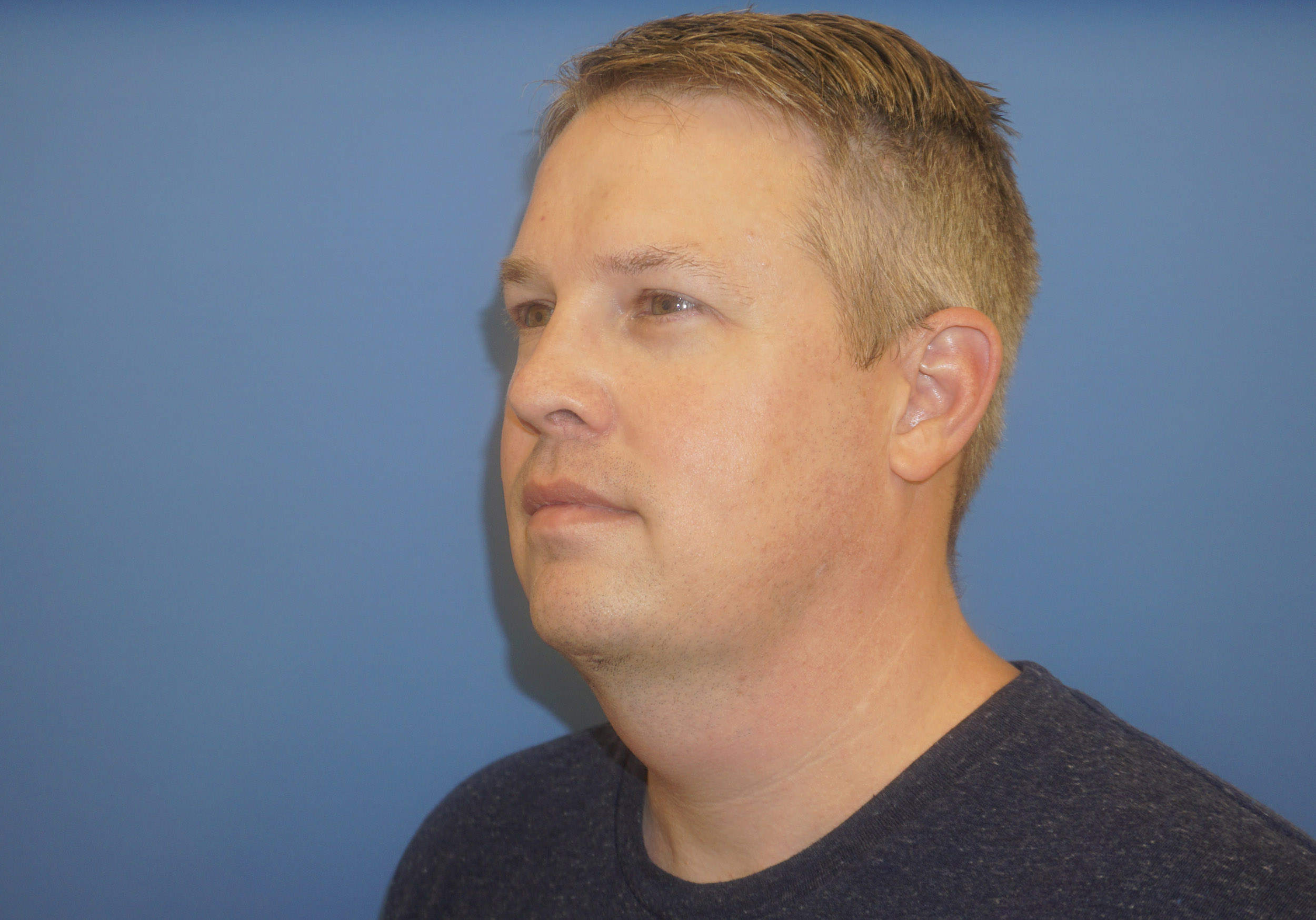 Liposuction – Patient 7 After Side