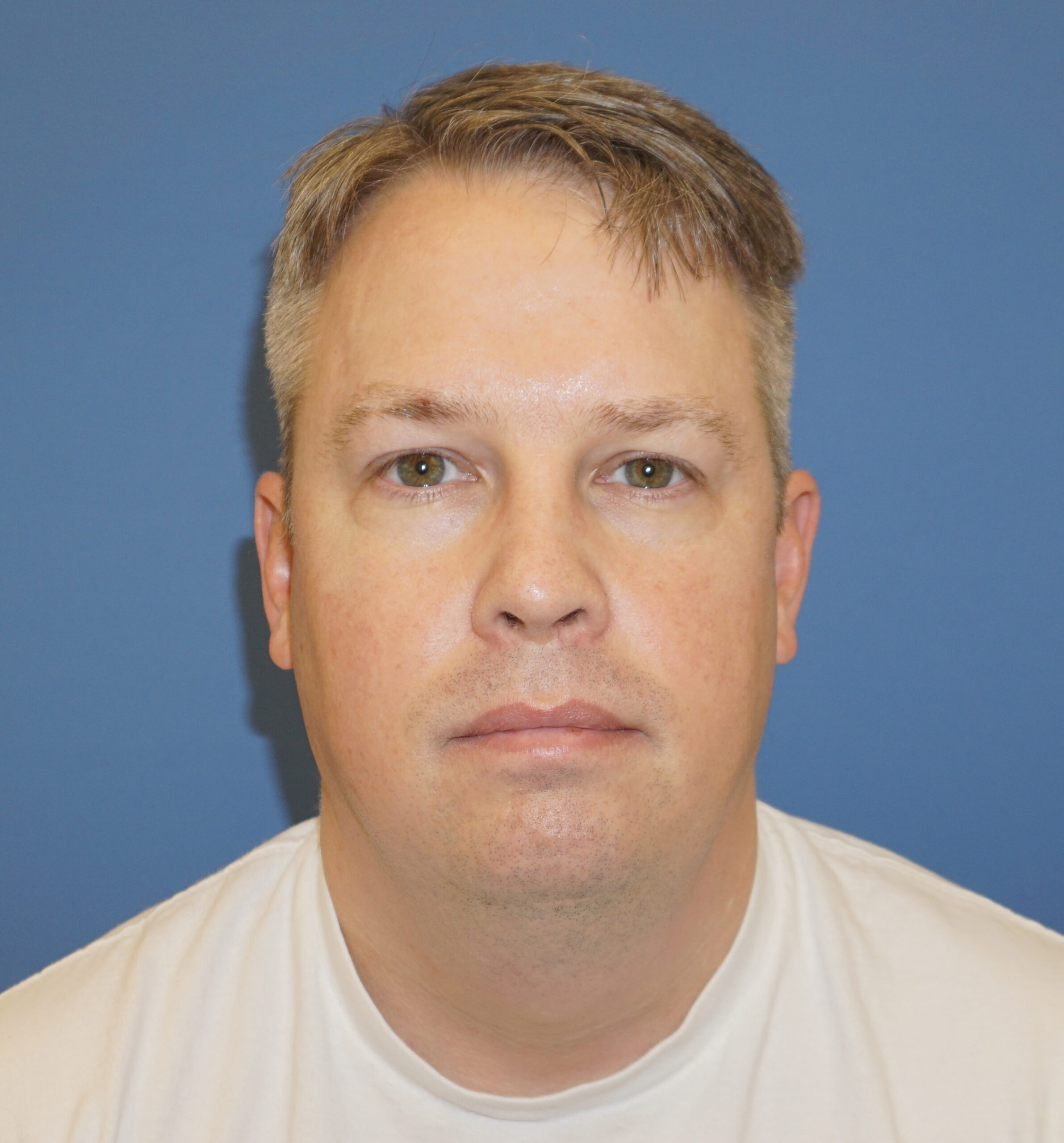 Liposuction – Patient 7 Before