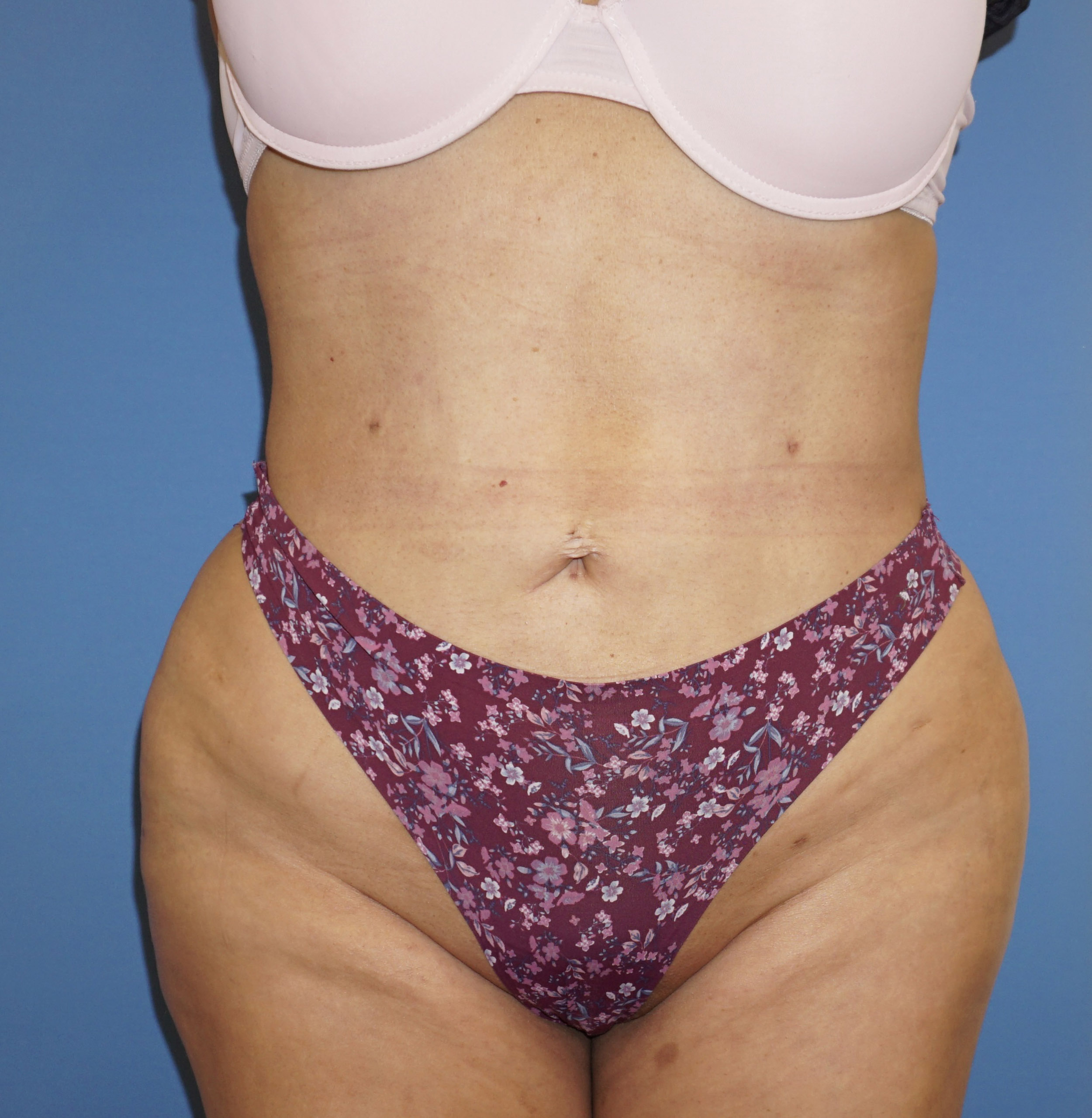 Liposuction – Patient 8 After