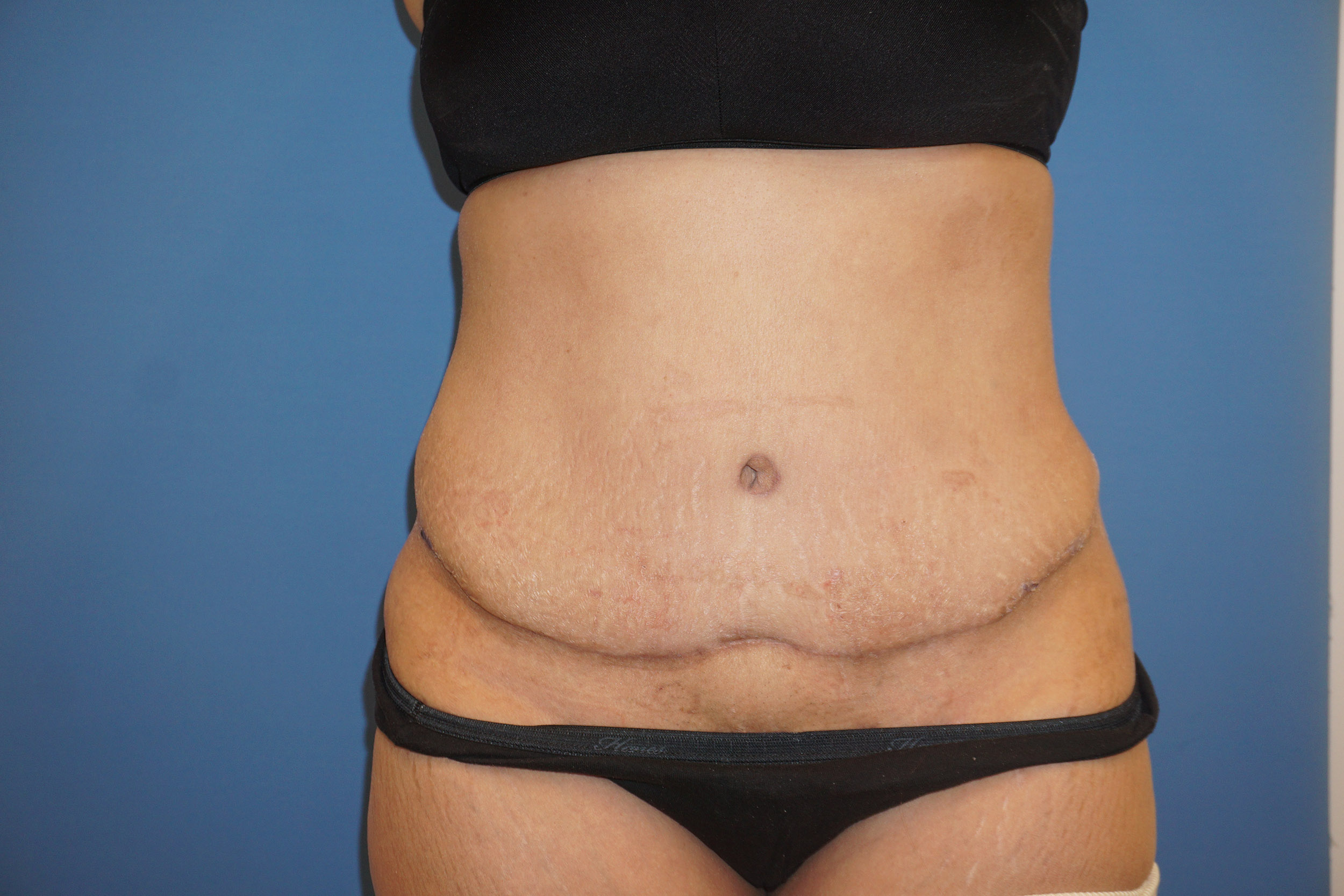 Tummy Tuck – Patient 8 After