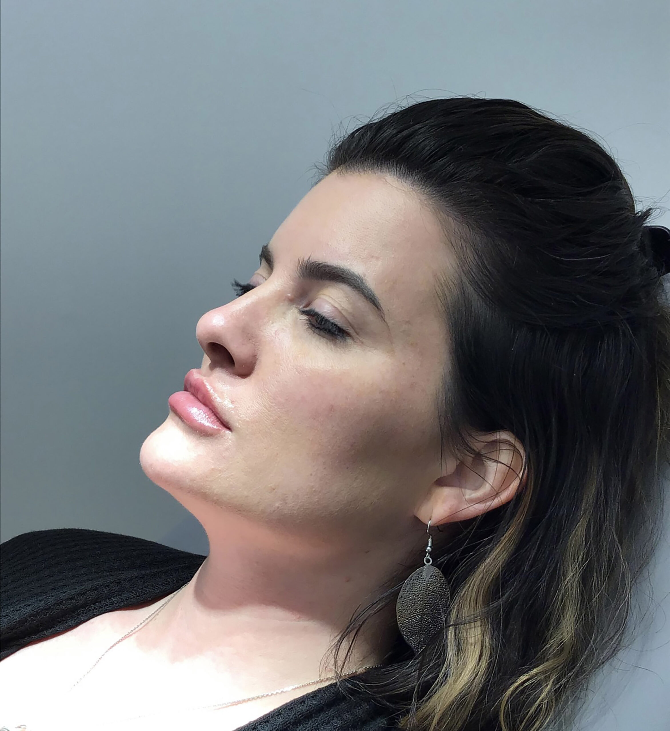 Botox – Patient 8 After