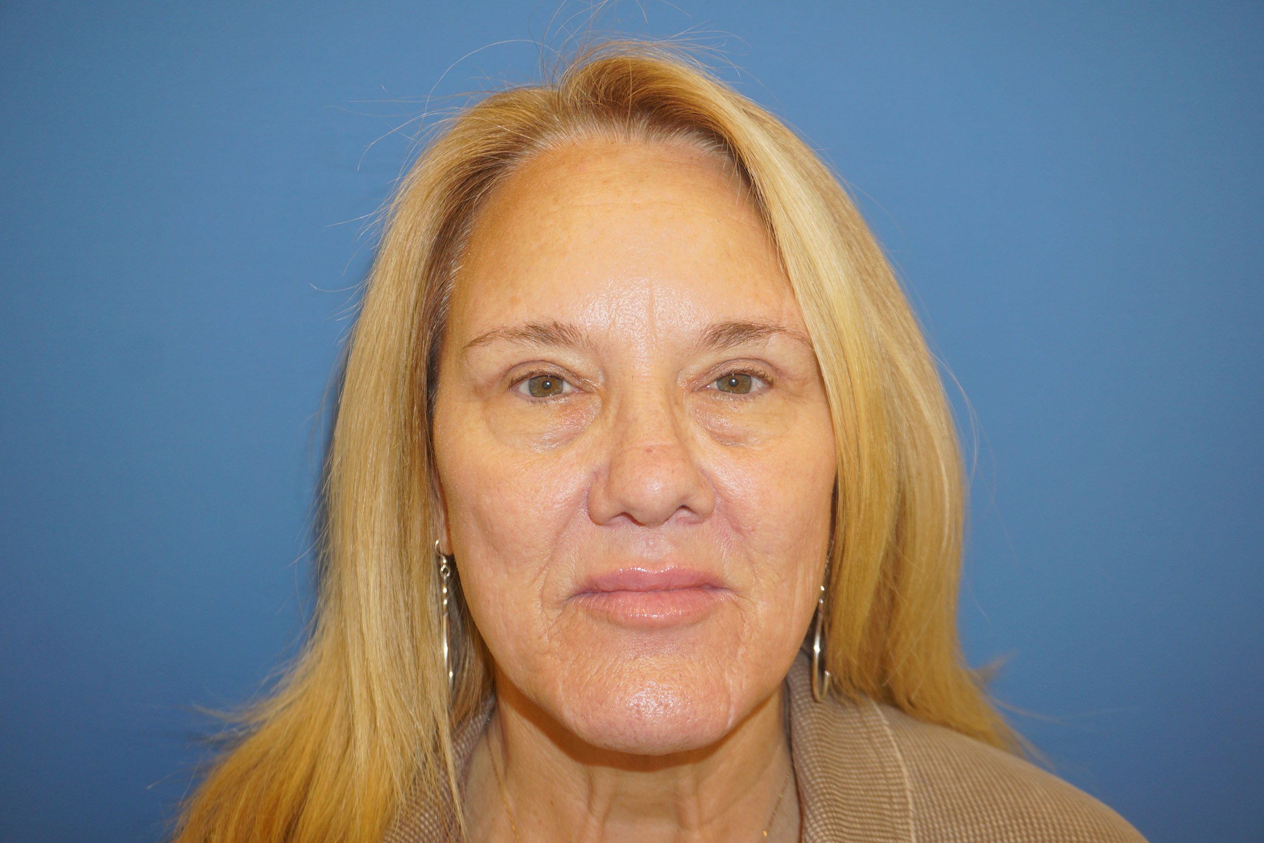 Blepharoplasty – Patient 7 After