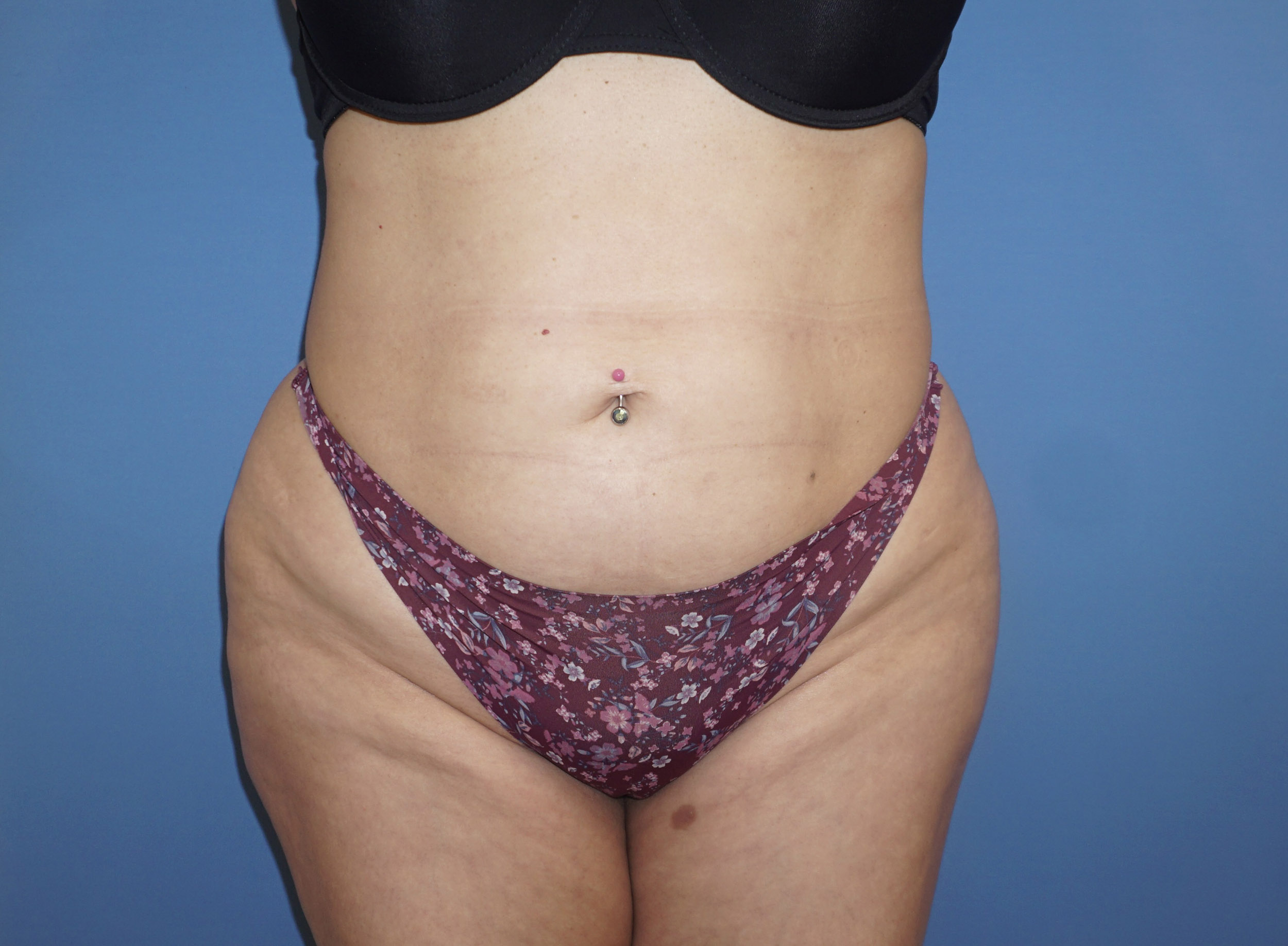 Liposuction – Patient 8 Before