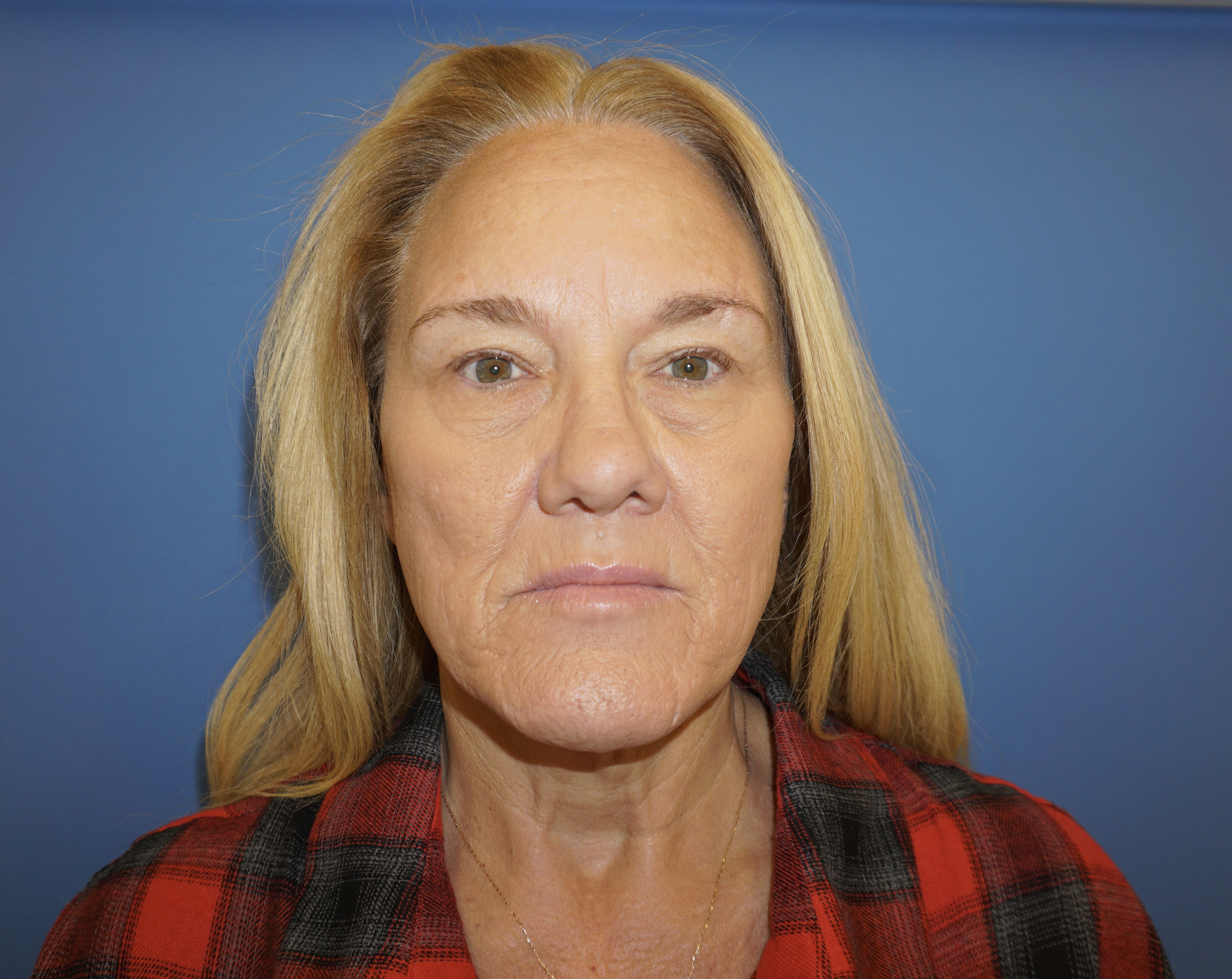 Blepharoplasty – Patient 7 Before