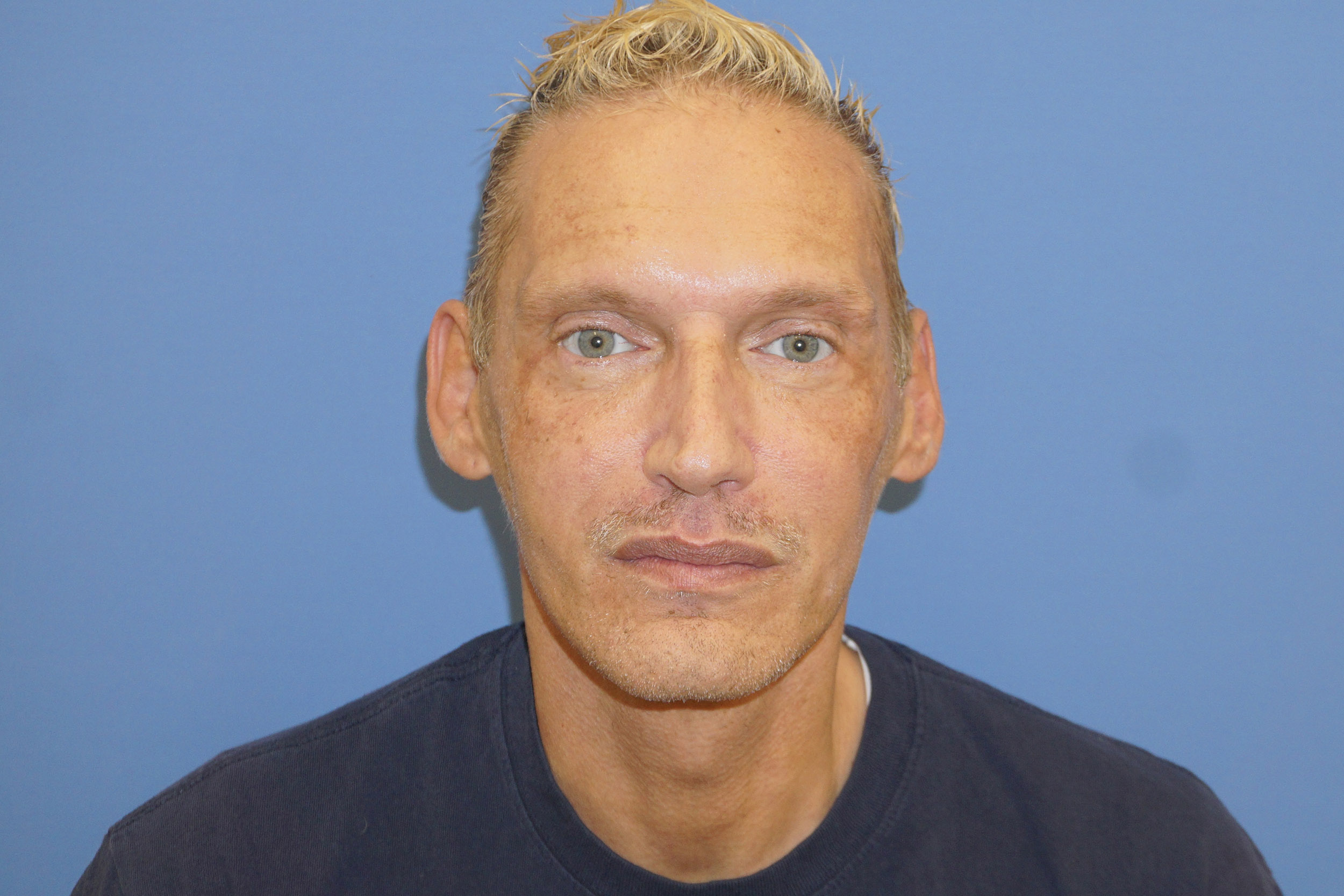 Botox – Patient 9 After