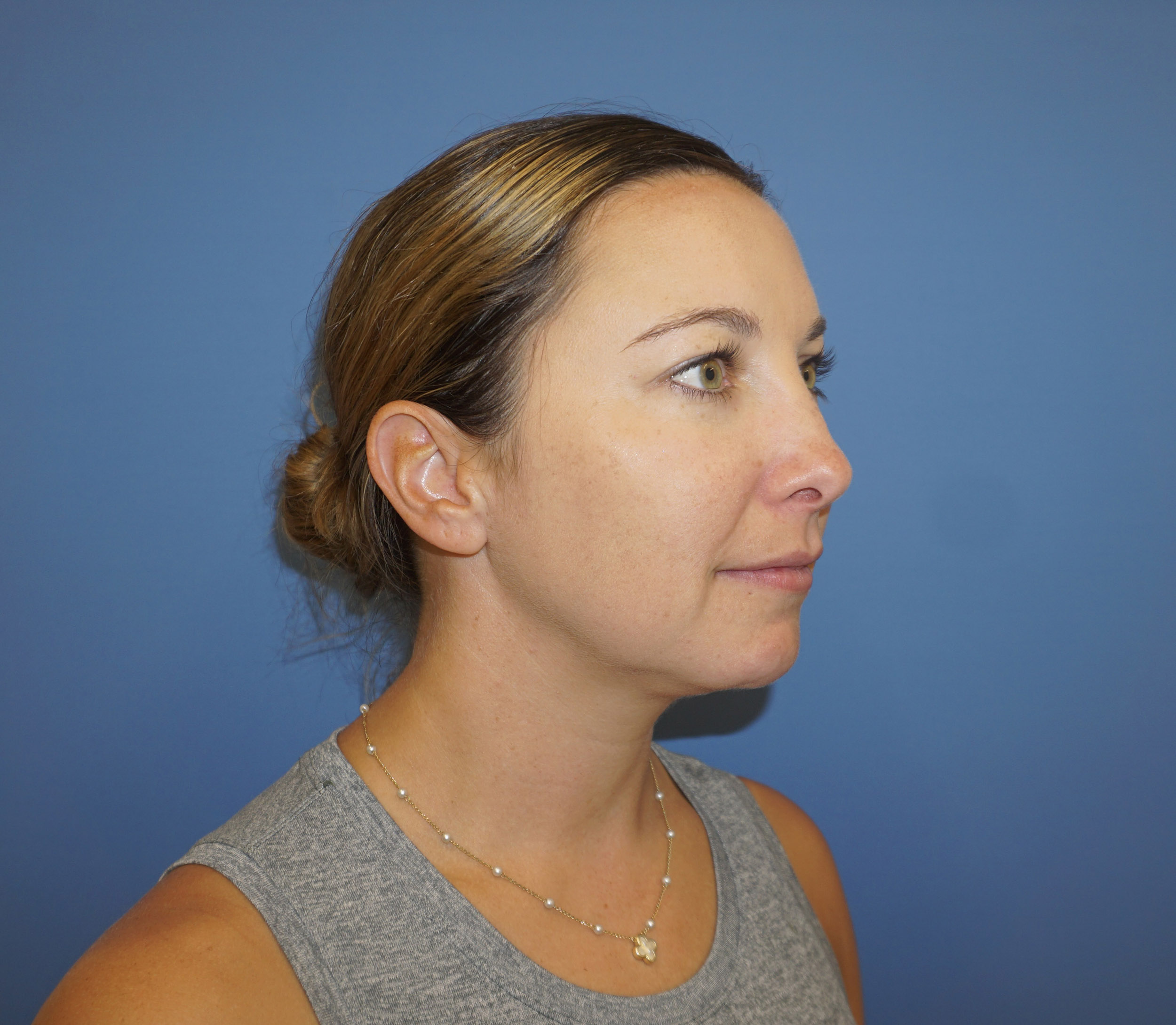 Liposuction – Patient 9 After