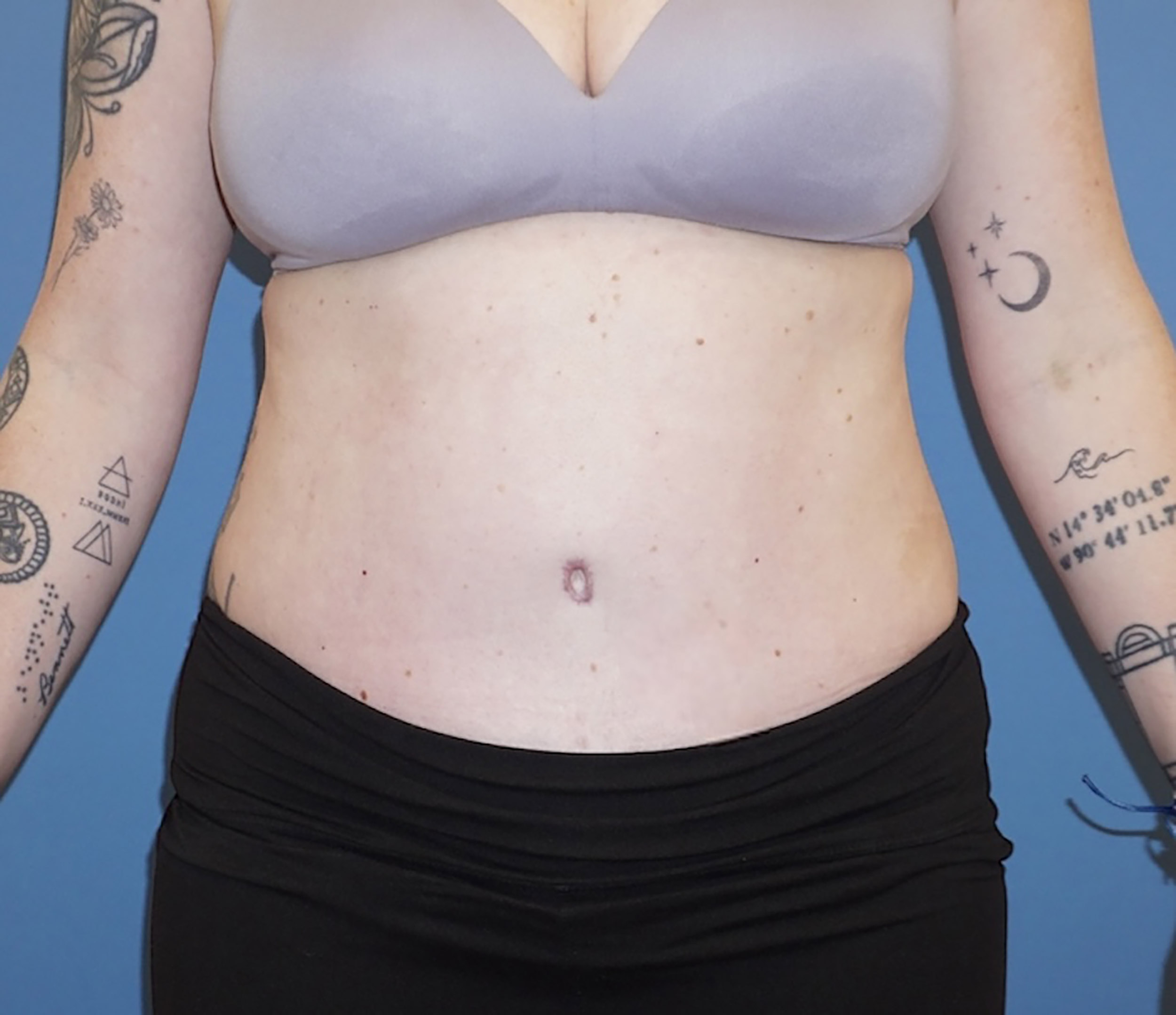 Tummy Tuck – Patient 9 After