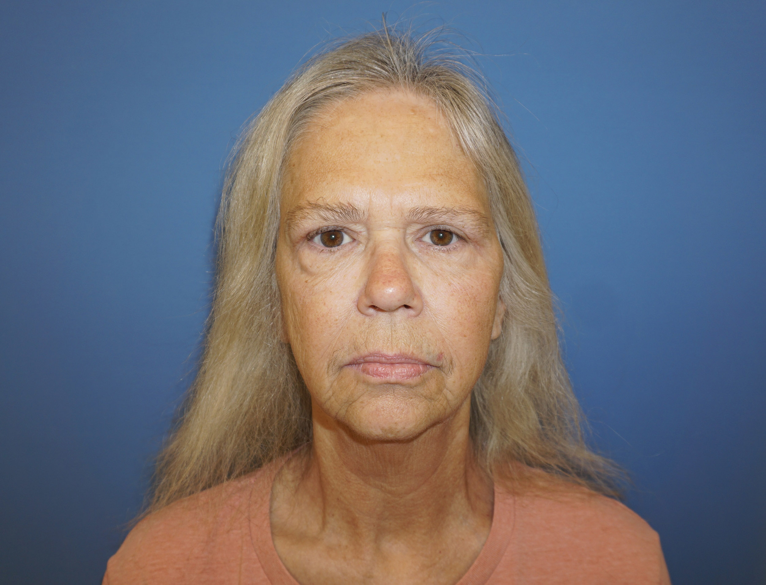 Blepharoplasty – Patient 9 After