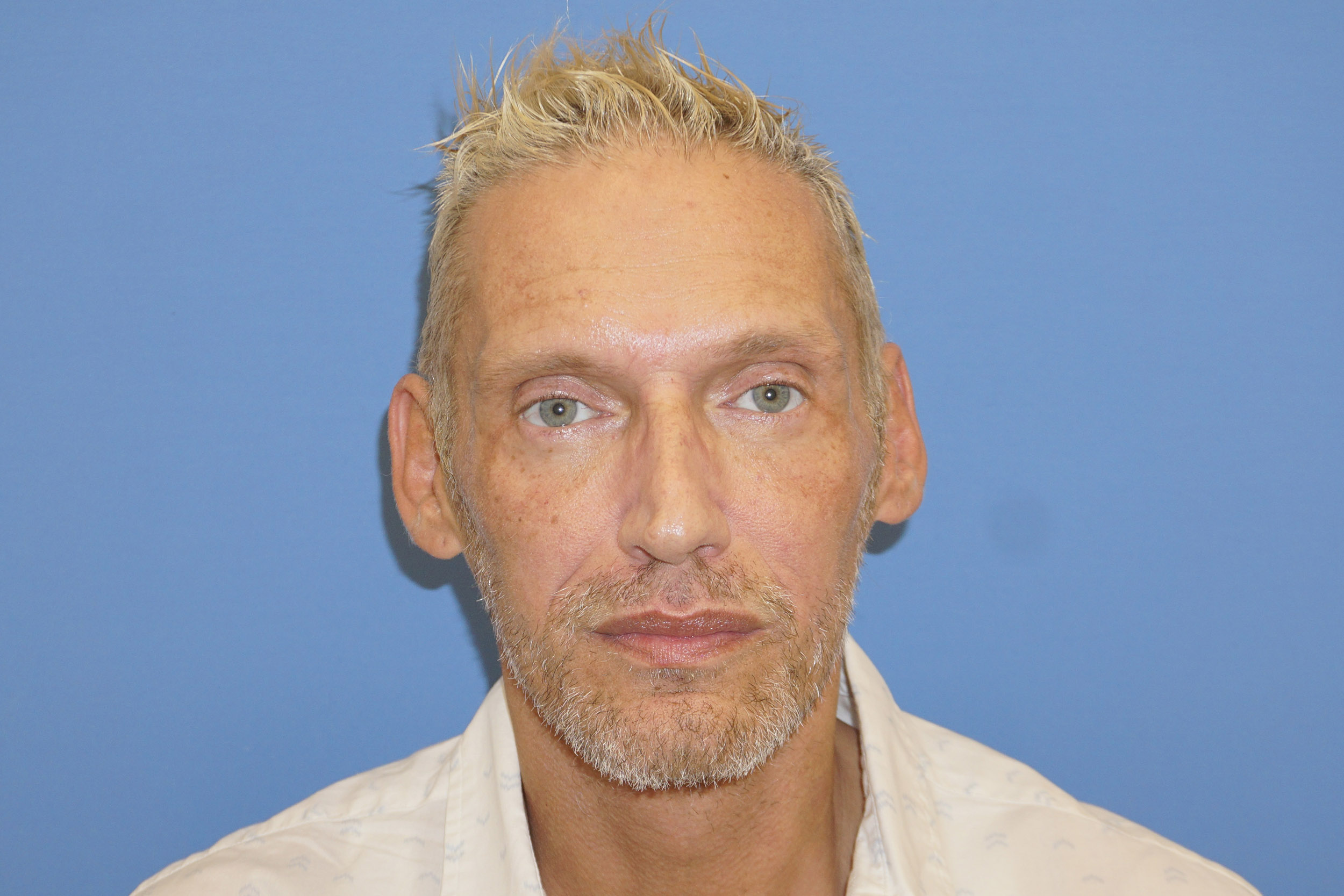 Botox – Patient 9 Before