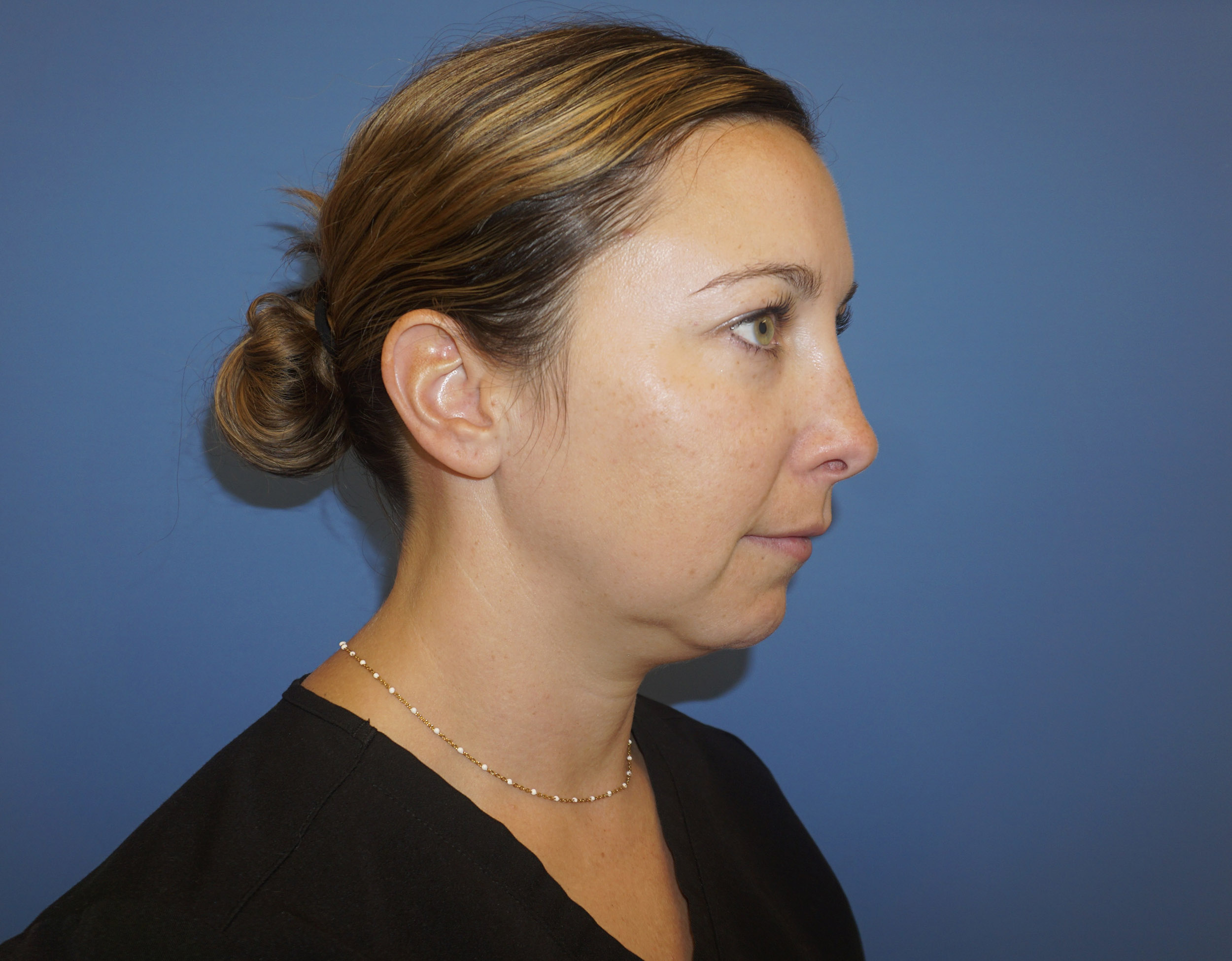 Liposuction – Patient 9 Before