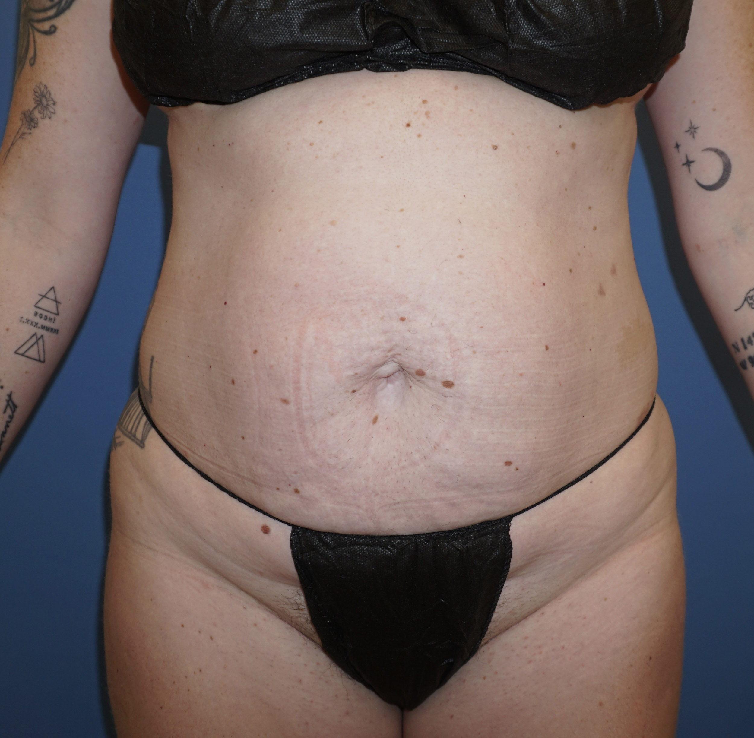 Tummy Tuck – Patient 9 Before